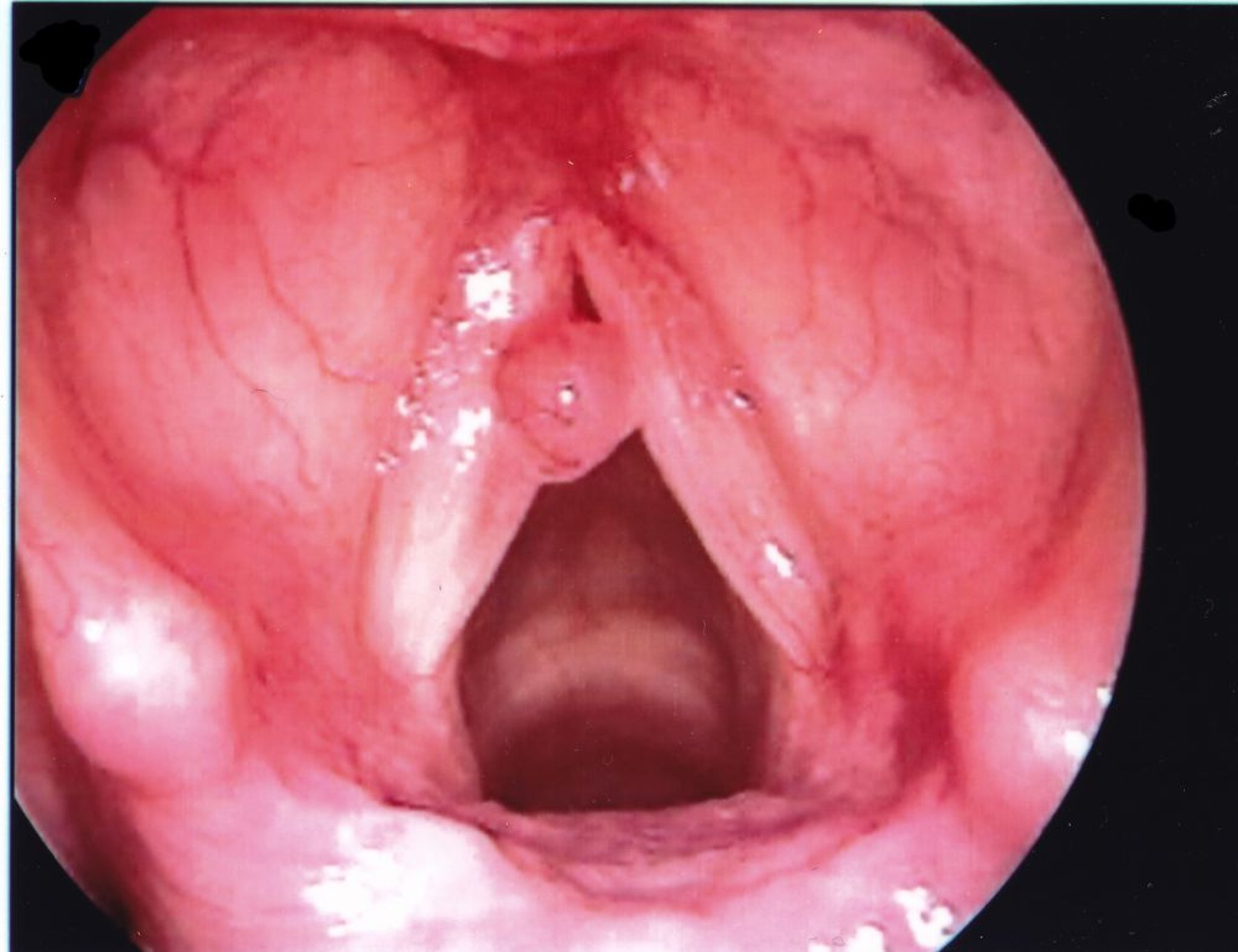 Pólipo de las cuerdas vocales
