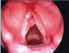 Polype des cordes vocales