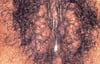 Kystes d'inclusion épidermique vulvaires