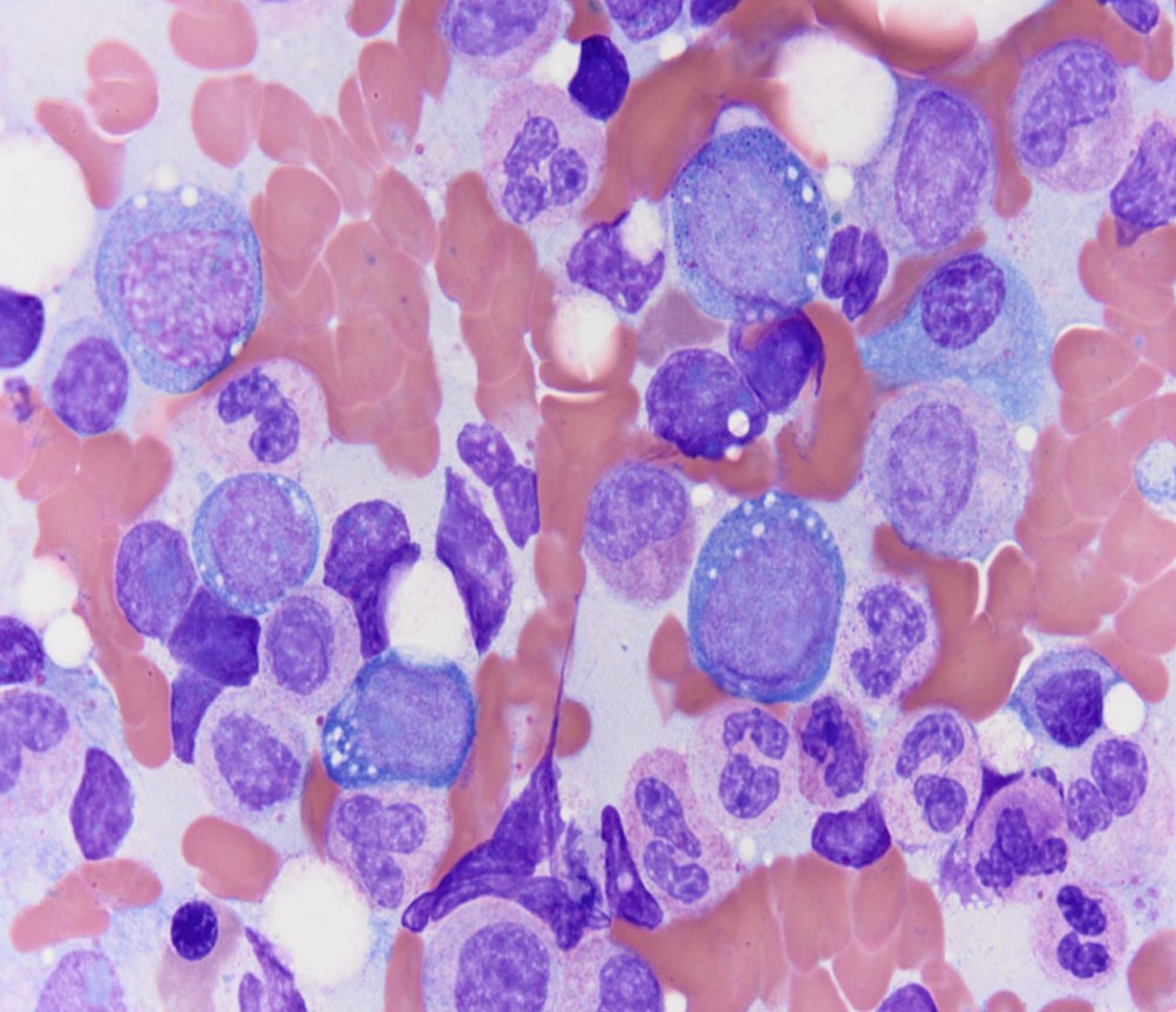 Vacuoles in VEXAS Syndrome