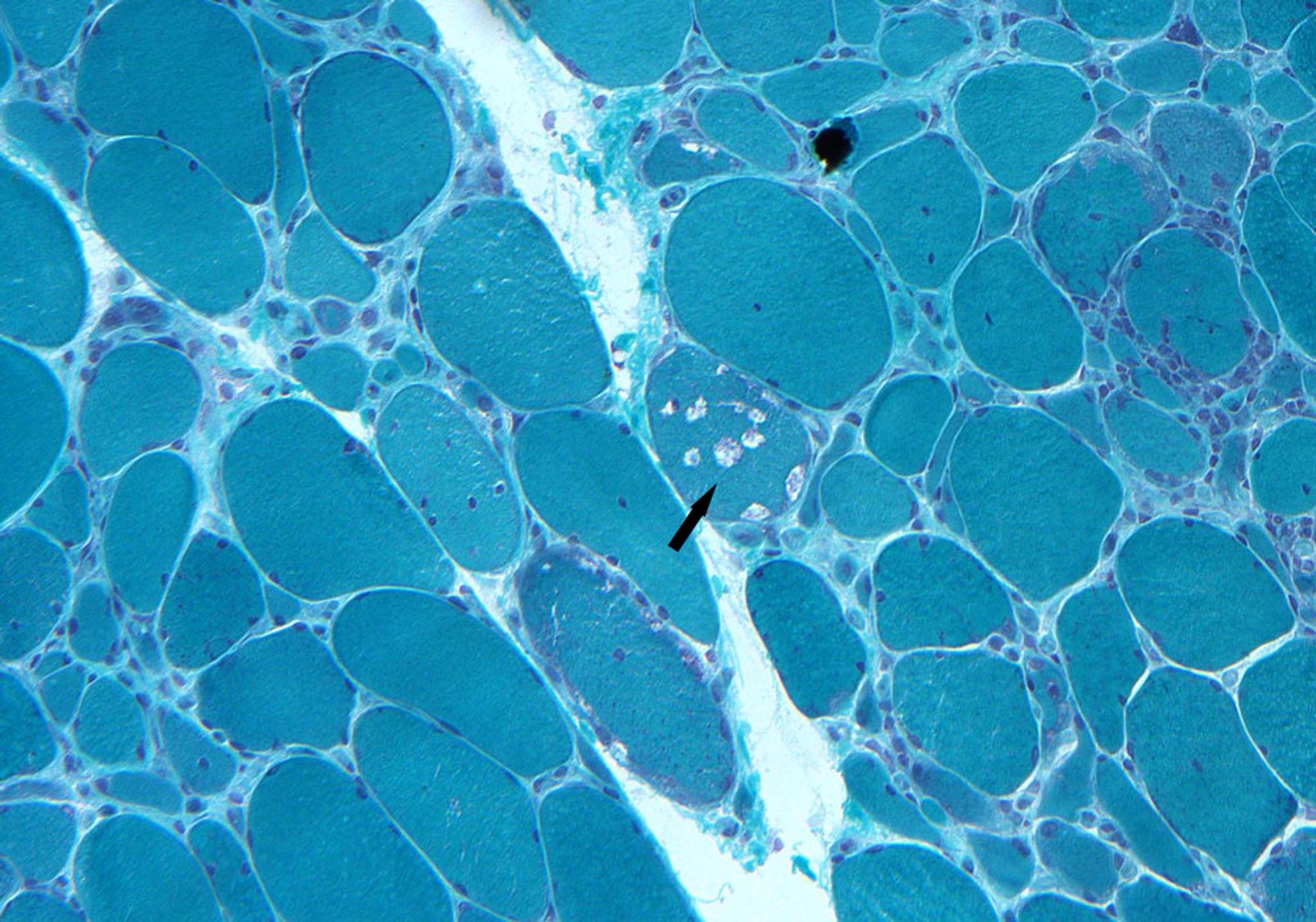 Inclusion Body Myositis