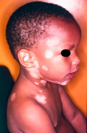 Vitiligo (criança)