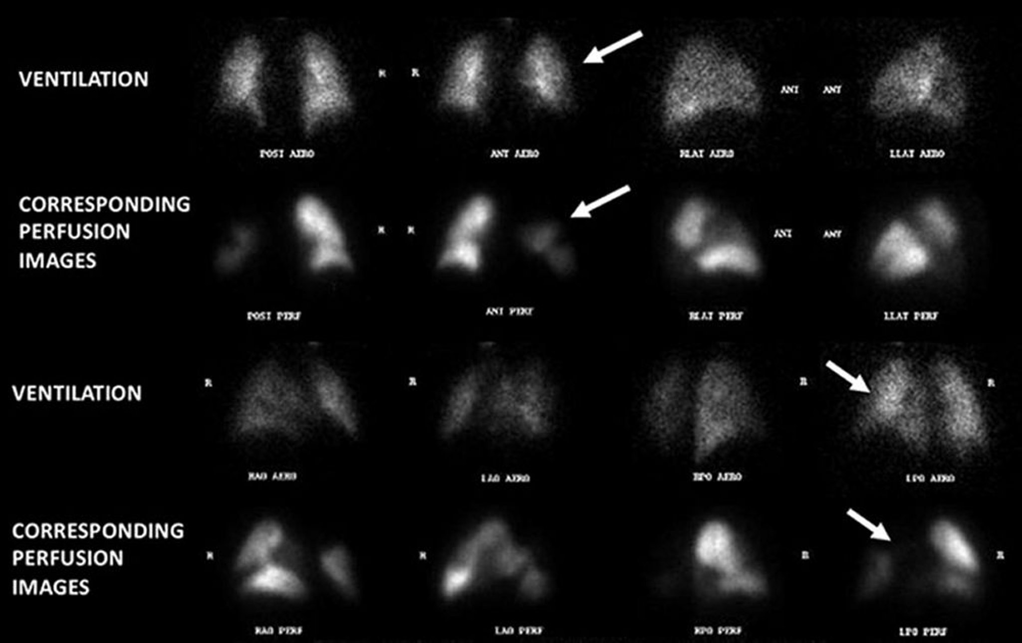 肺塞栓症（換気血流シンチグラフィー）