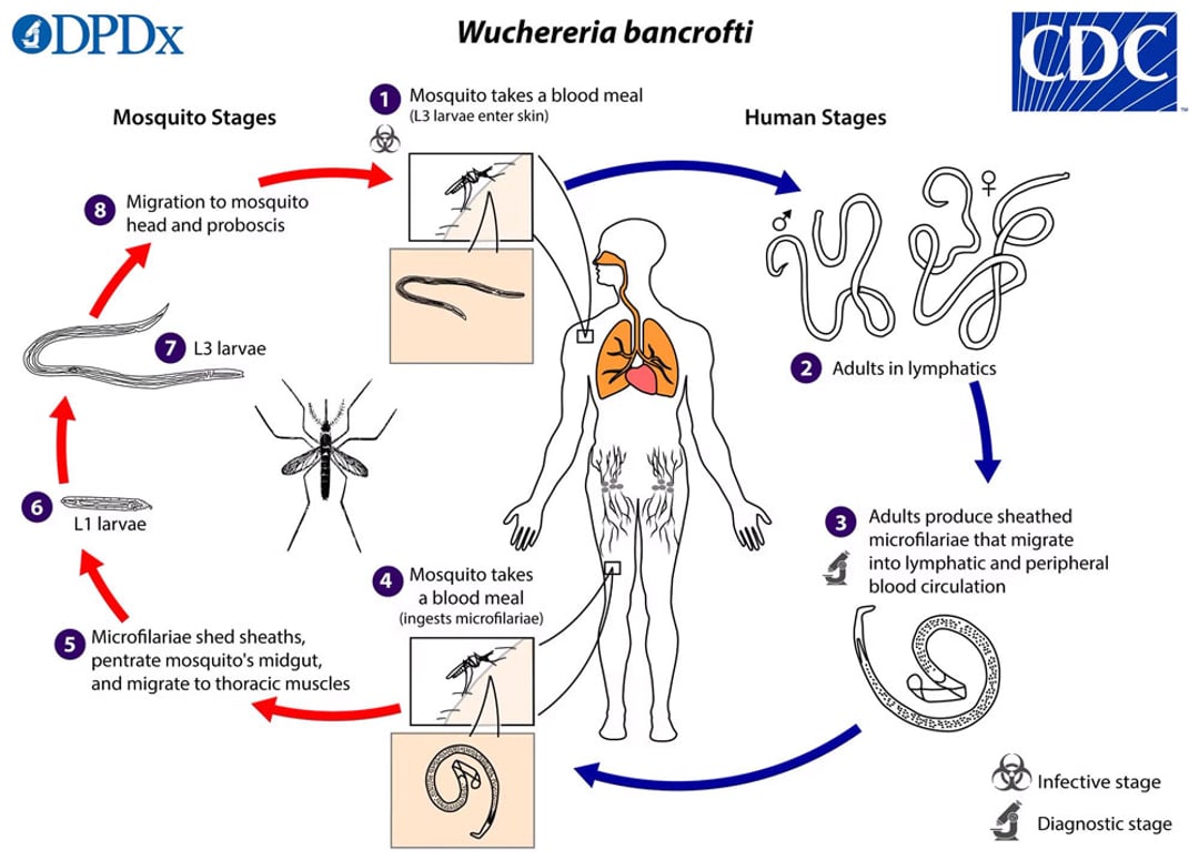 Bancroftian Lymphatic Filariasis And Brugian Lymphatic Filariasis bancroftian-lymphatic-filariasis-and-brugian-lymphatic-filariasis