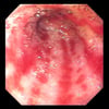 Gastric Antral Vascular Ectasia (Watermelon Stomach)