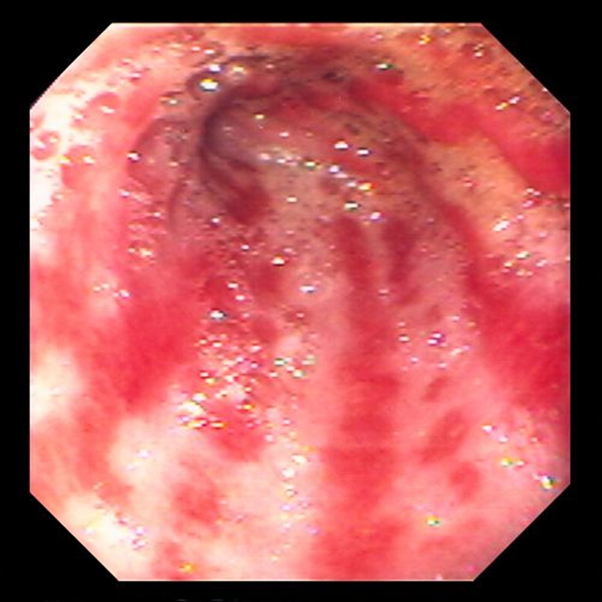 Ectasia vascular antral gástrica (estómago de sandía)