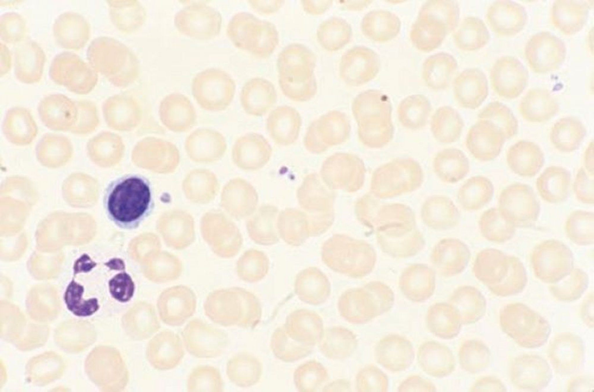 Colorazione di Wright-Giemsa dello striscio di sangue periferico