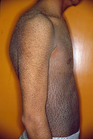 Ichtyose liée à l'X