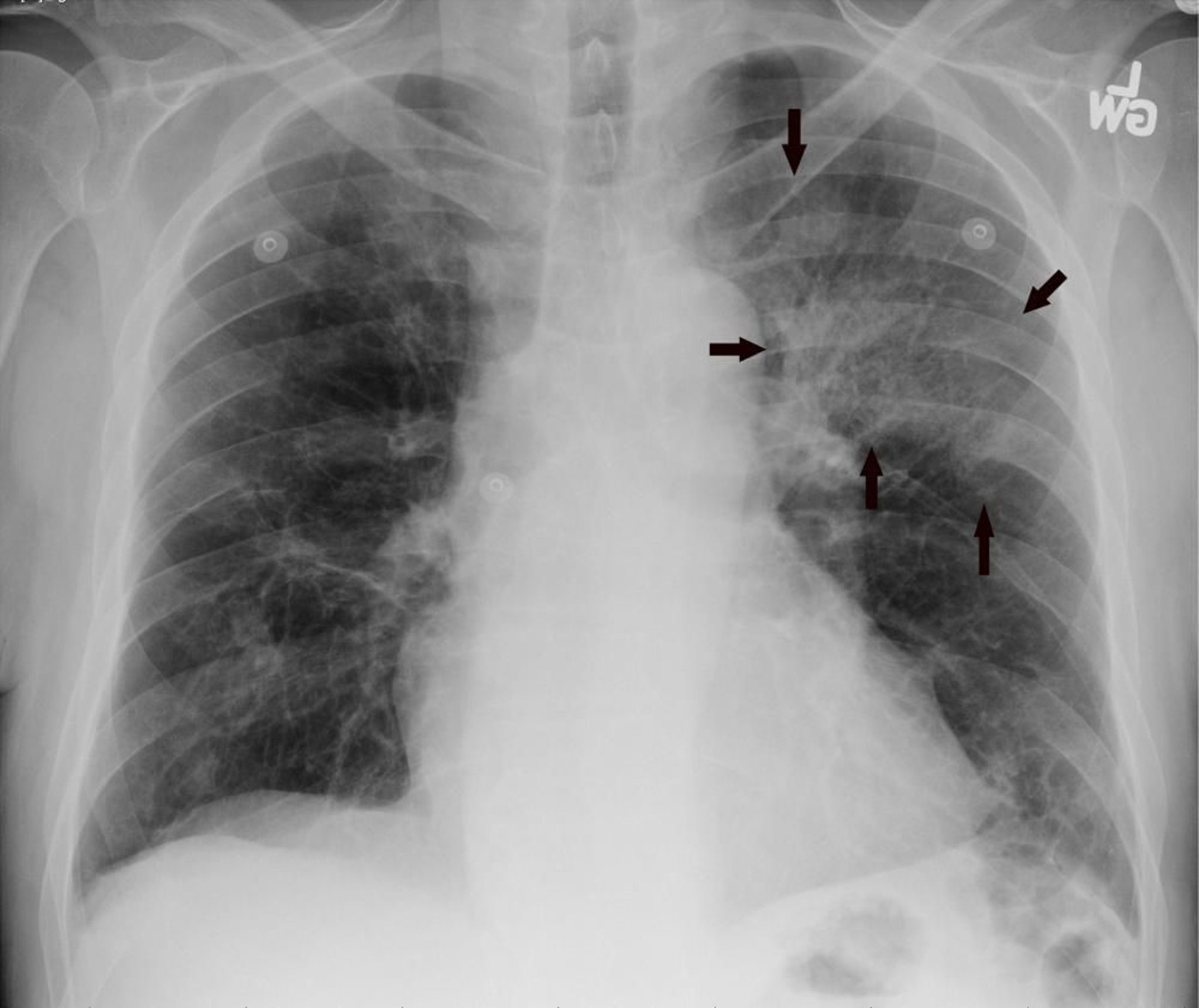 Radiographie du thorax