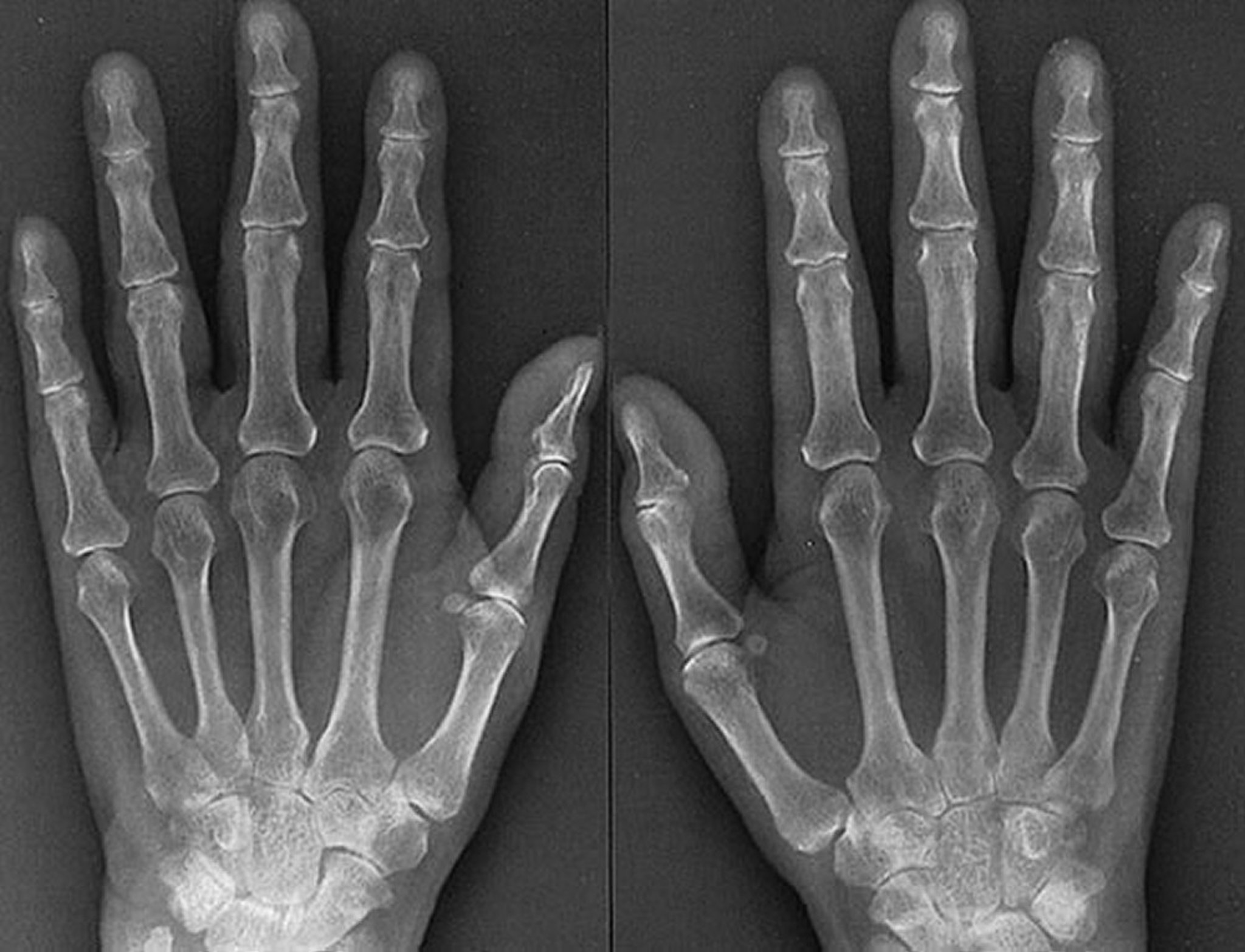 X-Ray Features of Early Rheumatoid Arthritis