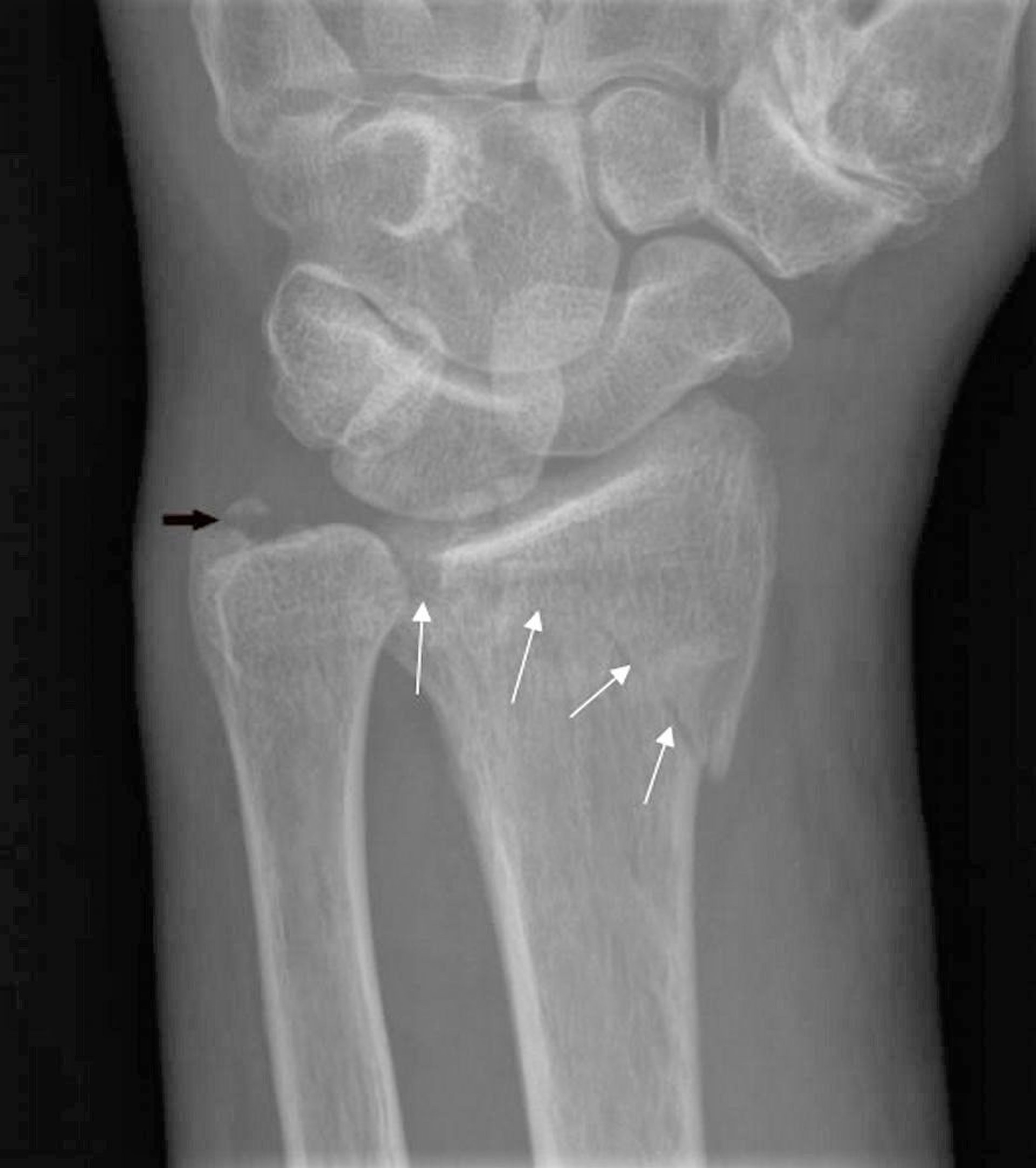 Radiographie du poignet gauche