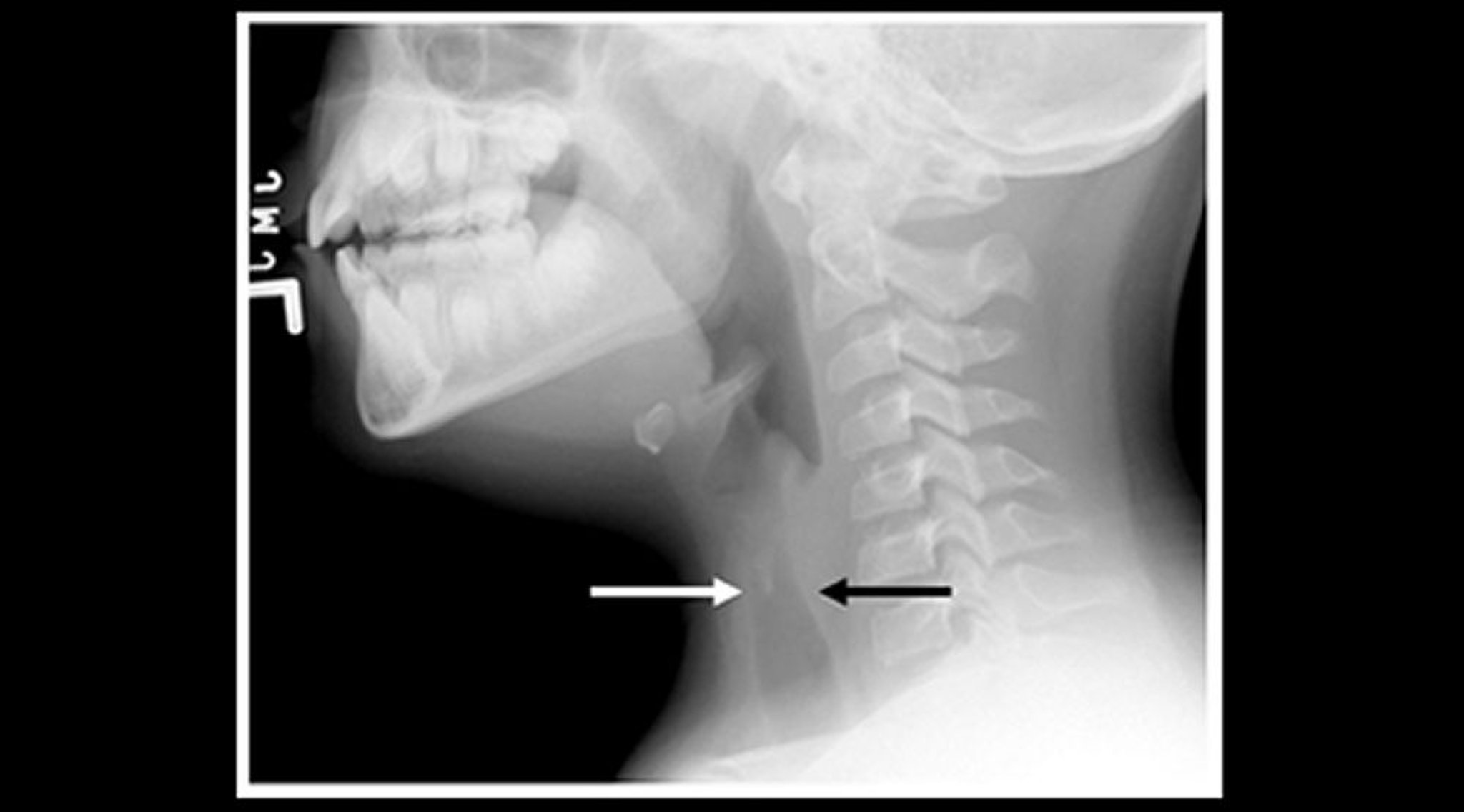 Radiografía de un niño con laringotraqueobronquitis espasmódica (crup) (cista sagital)