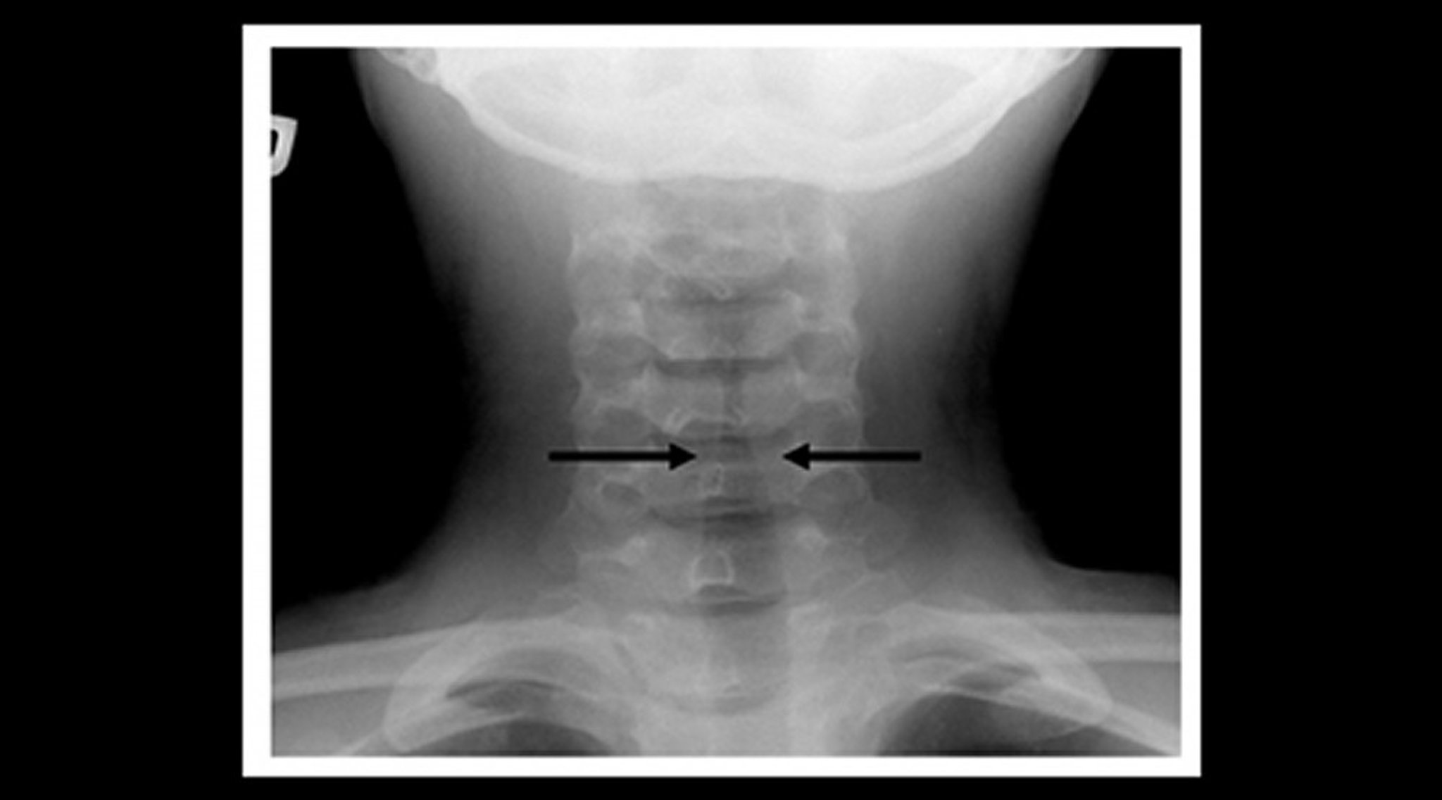 Radiograph of a Child With Croup (Coronal View)