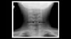 Radiografía de un niño con laringotraqueobronquitis espasmódica (crup) (cista coronal)
