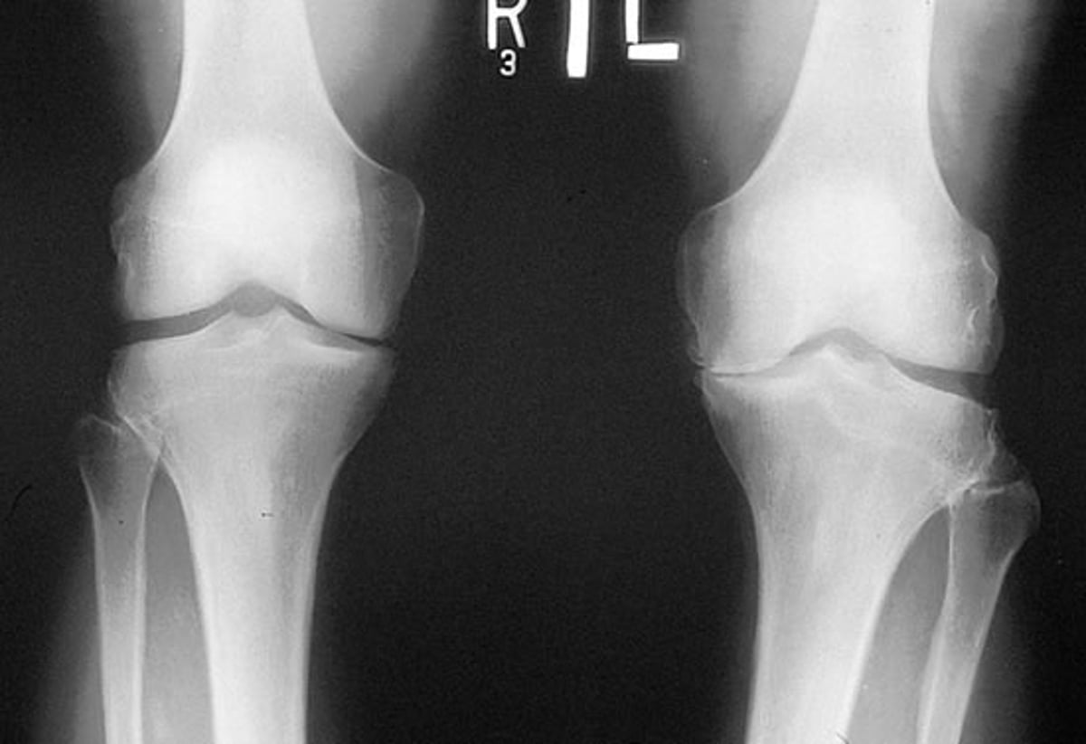 変形性関節症における膝関節のX線