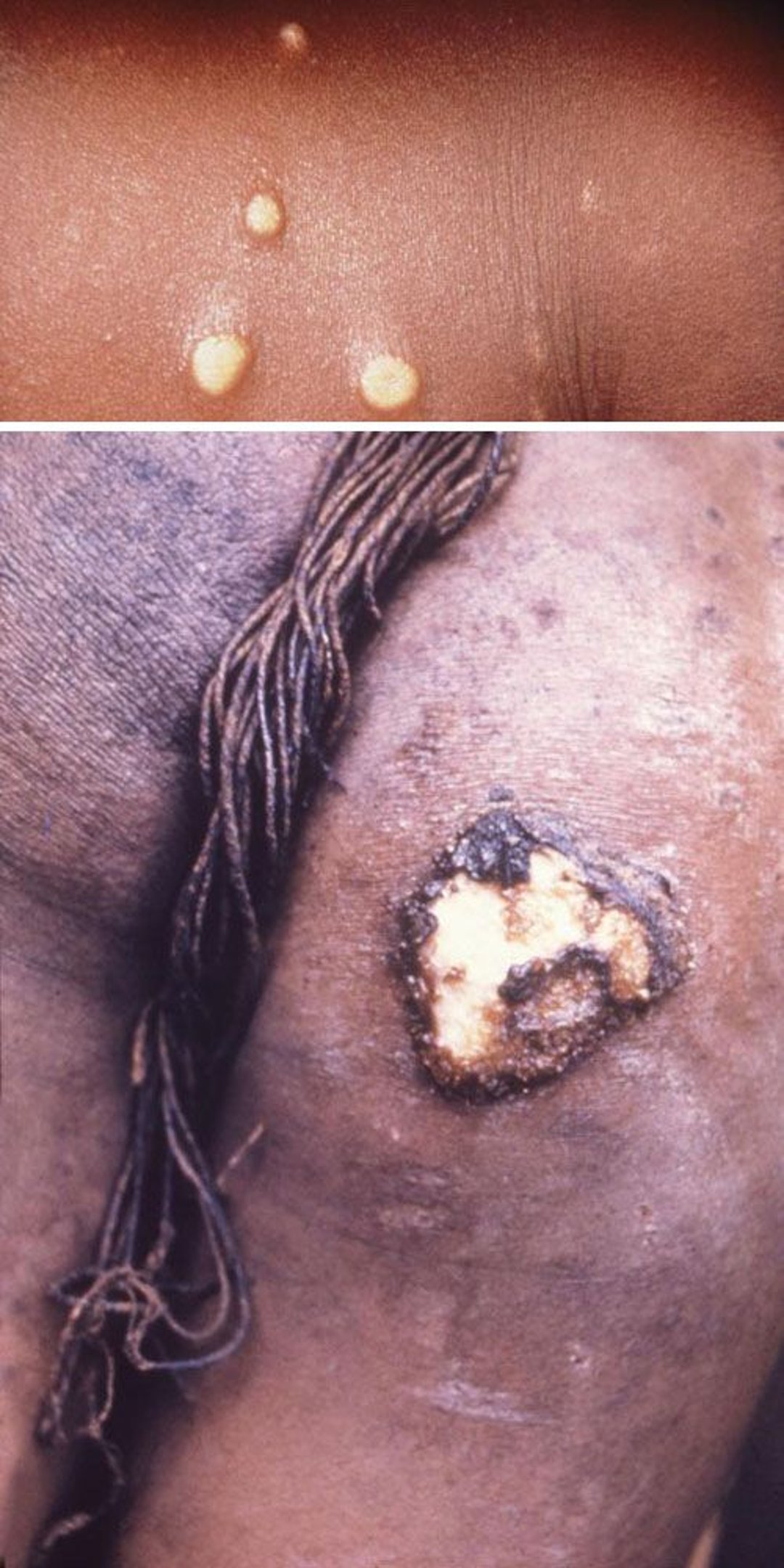 Bệnh ghẻ cóc – Nguyên phát