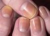 Nail Discoloration Due to Nail Polish