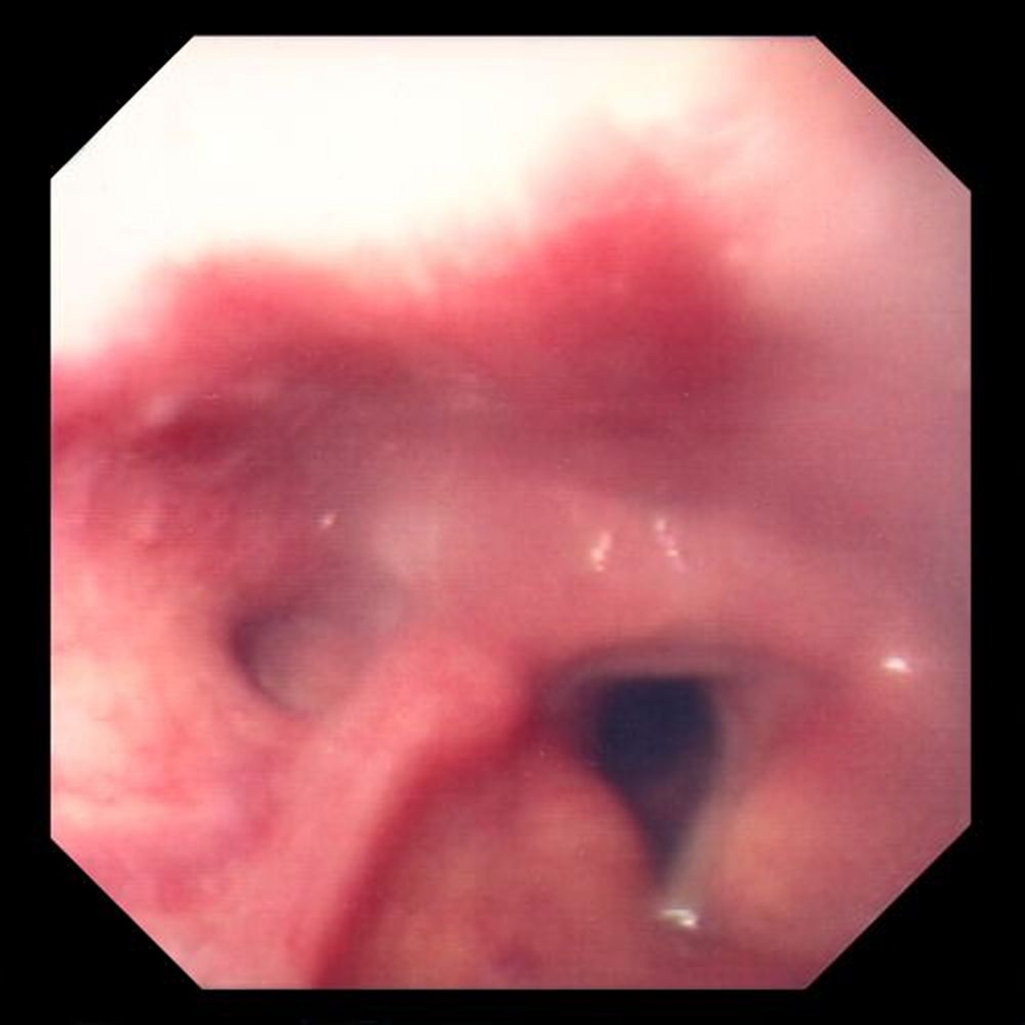 Diverticule de Zenker