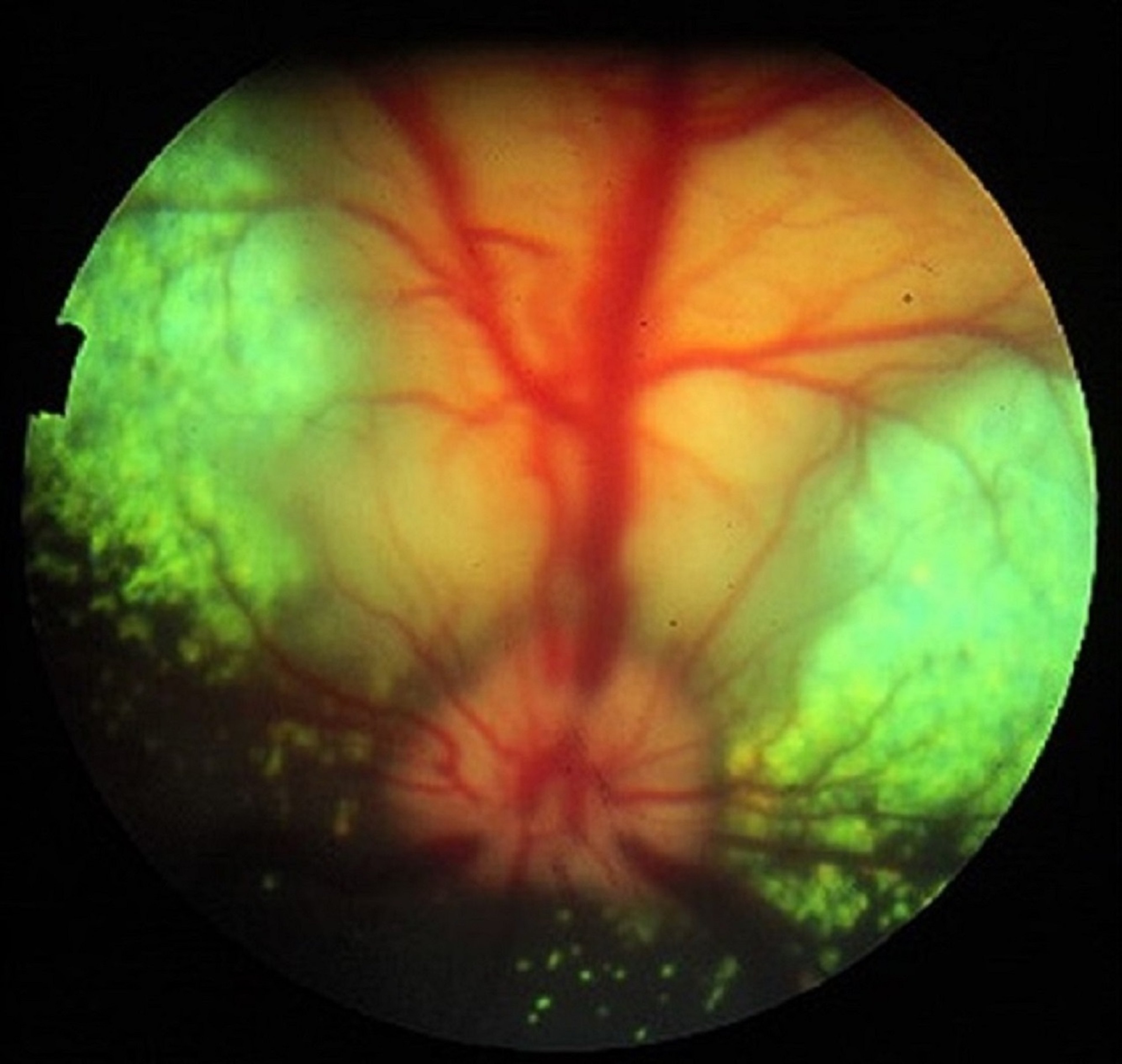 Active chorioretinitis secondary to systemic blastomycosis, dog