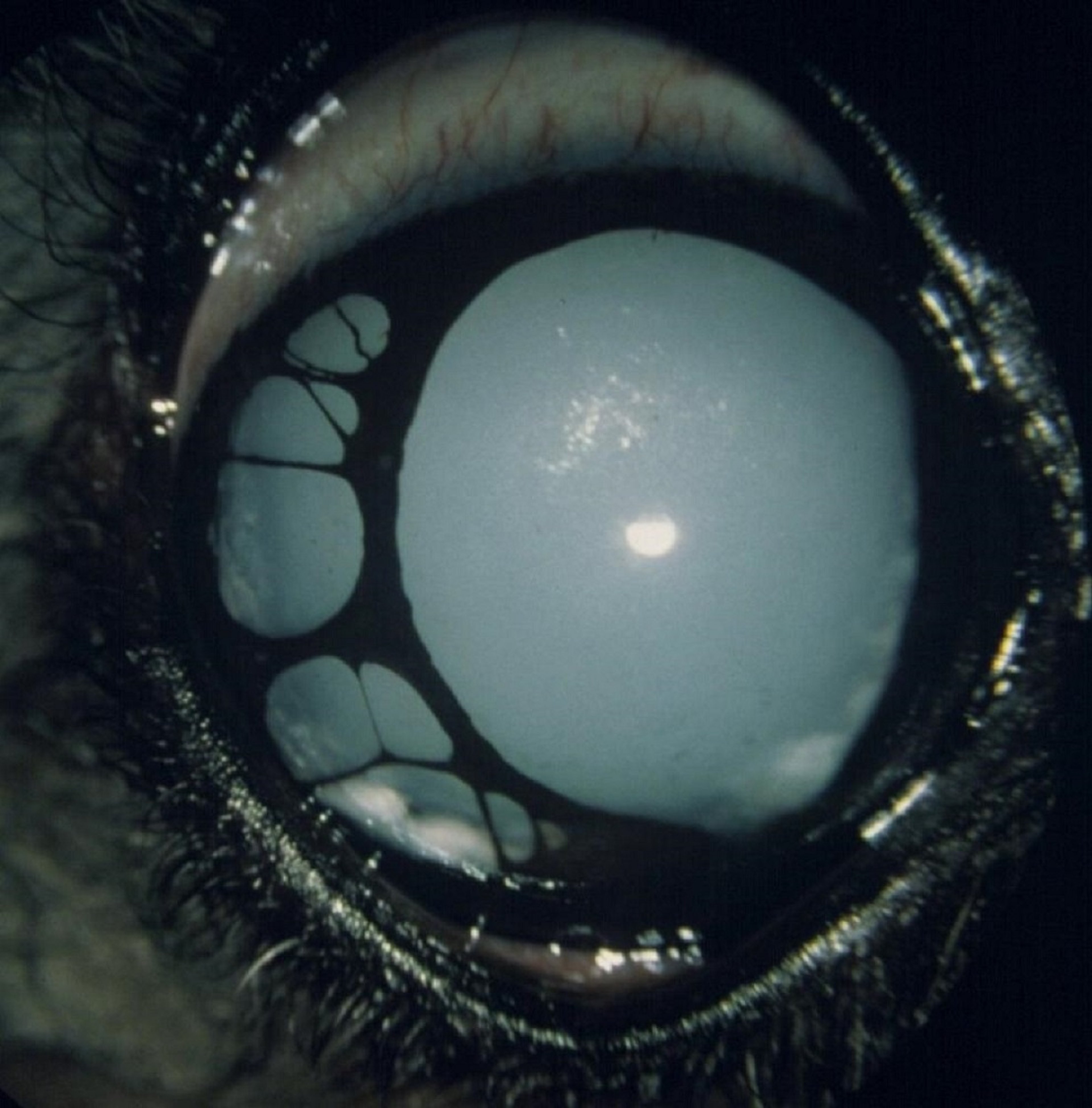 Advanced iris atrophy with complete cataract formation, dog