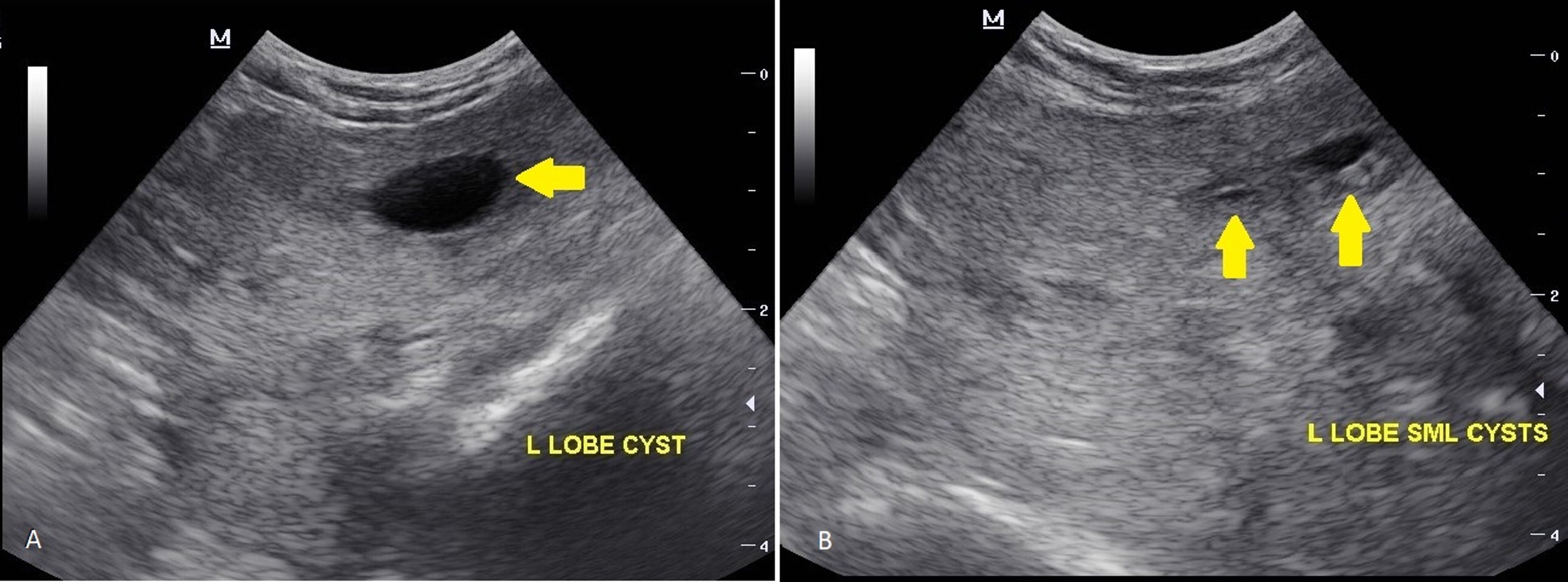 Anechoic areas within the parenchyma, transabdominal ultrasonography