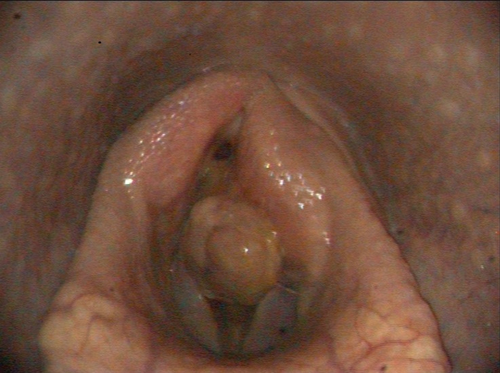Arytenoid chondritis with granuloma, horse