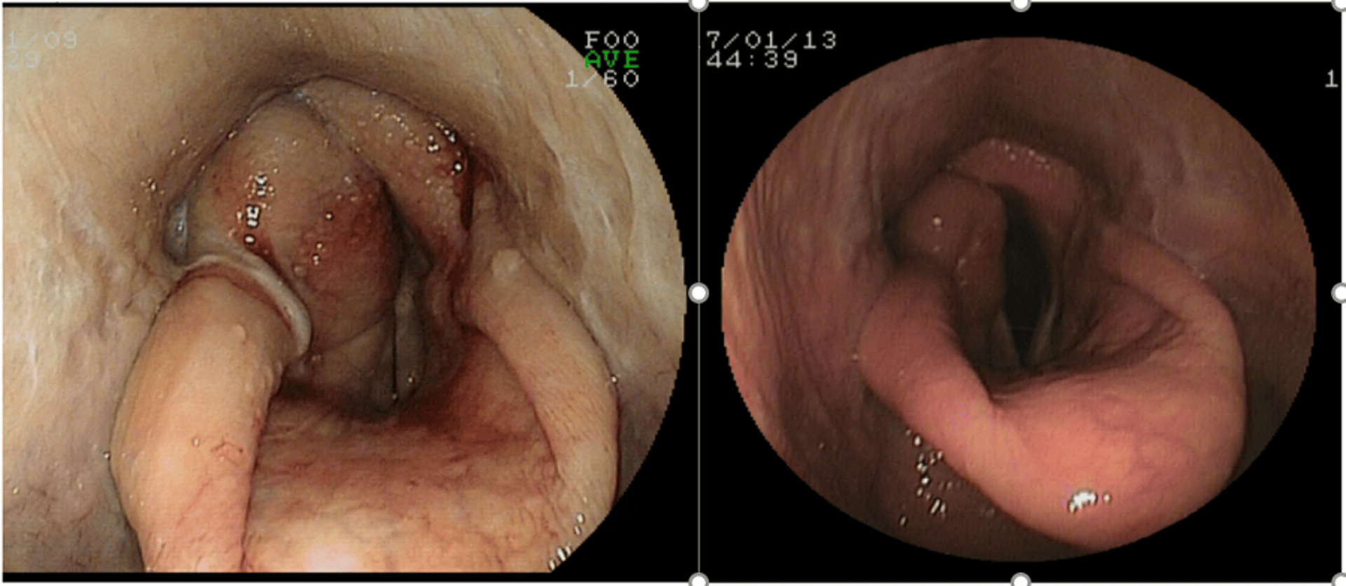 Arytenoid chondropathy, horse