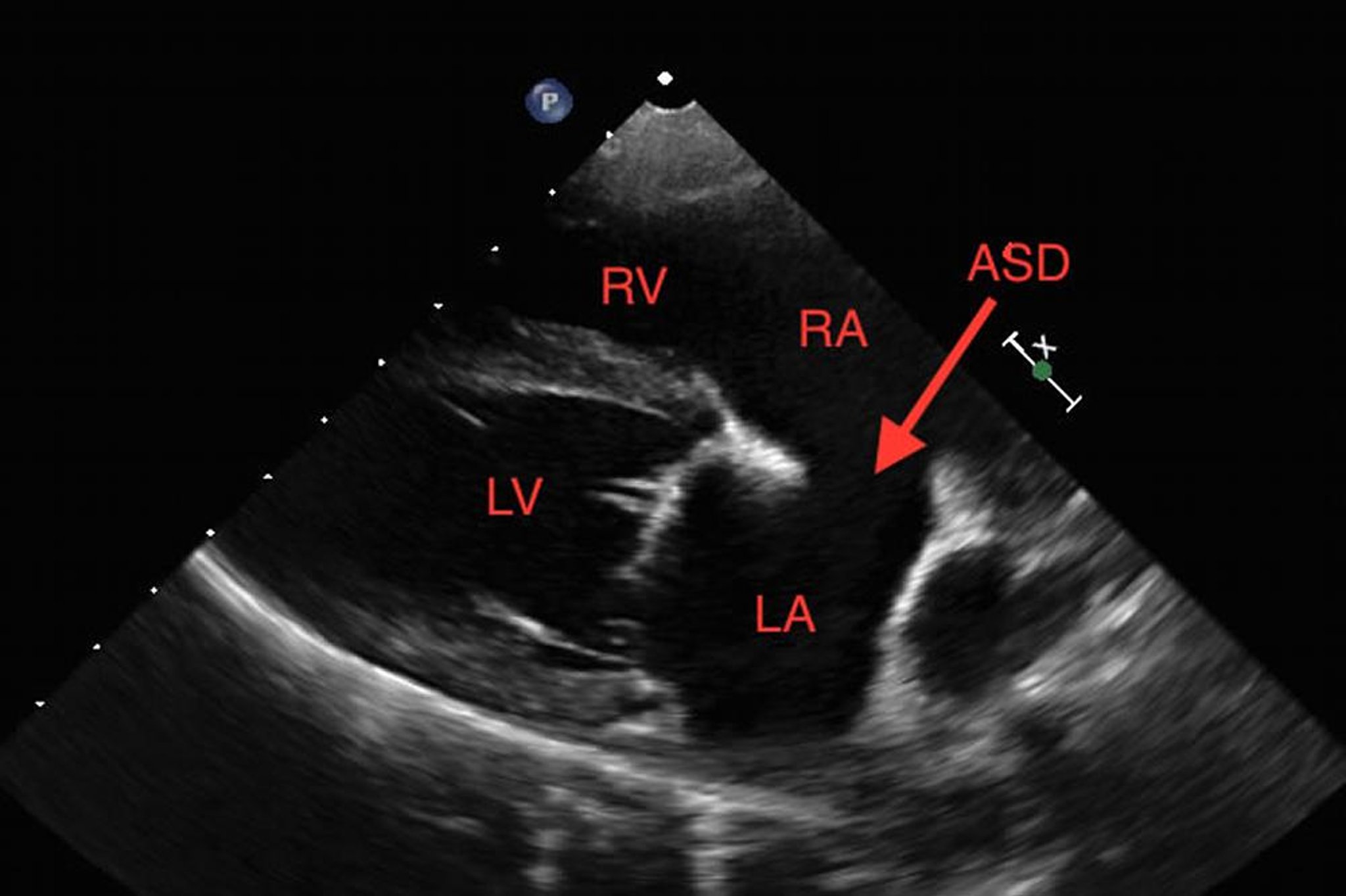 Atrial septal defect, dog, echocardiogram