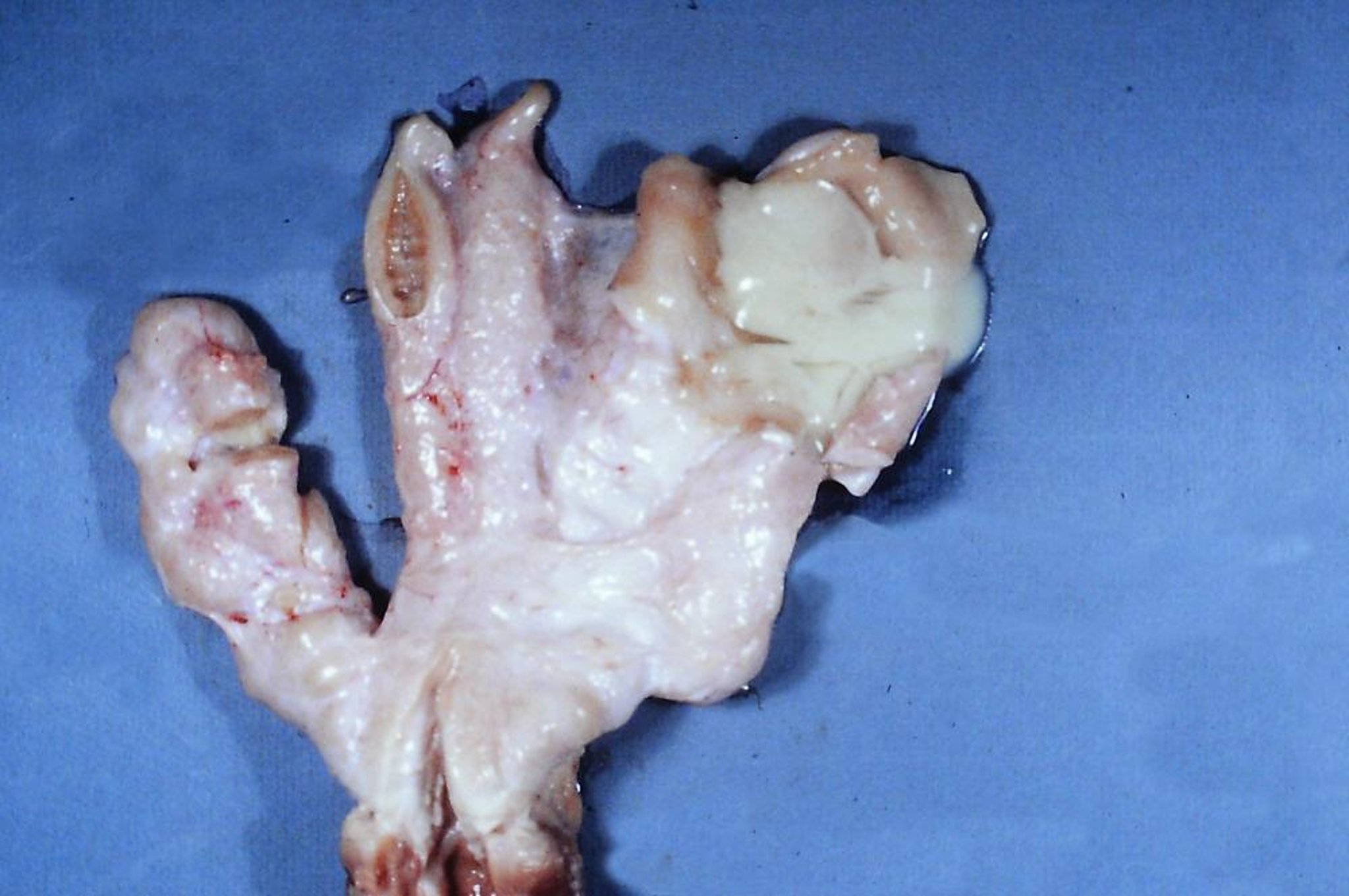 Abscess, pelvic genitalia, bull