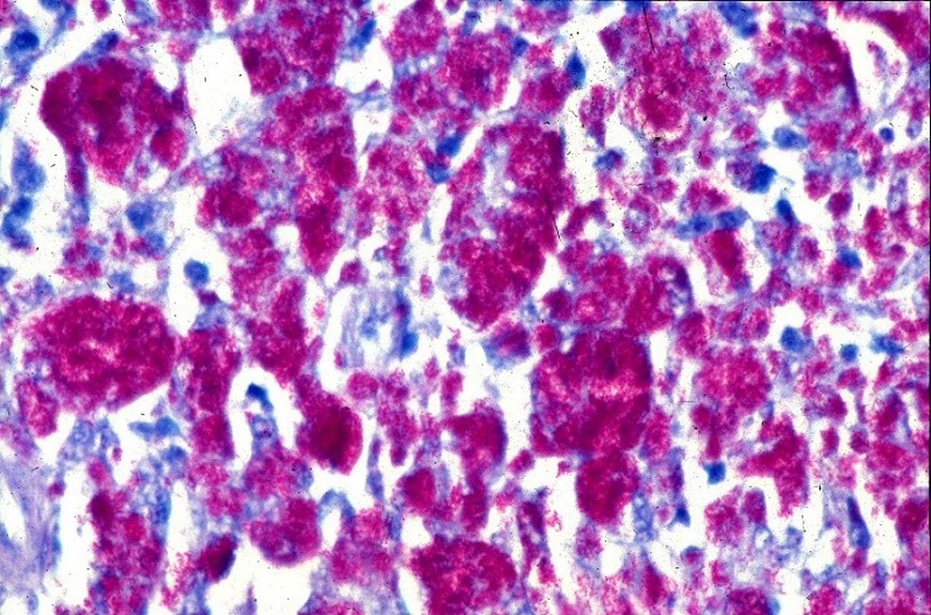 Lámina propia intestinal, bacilos acidorresistentes