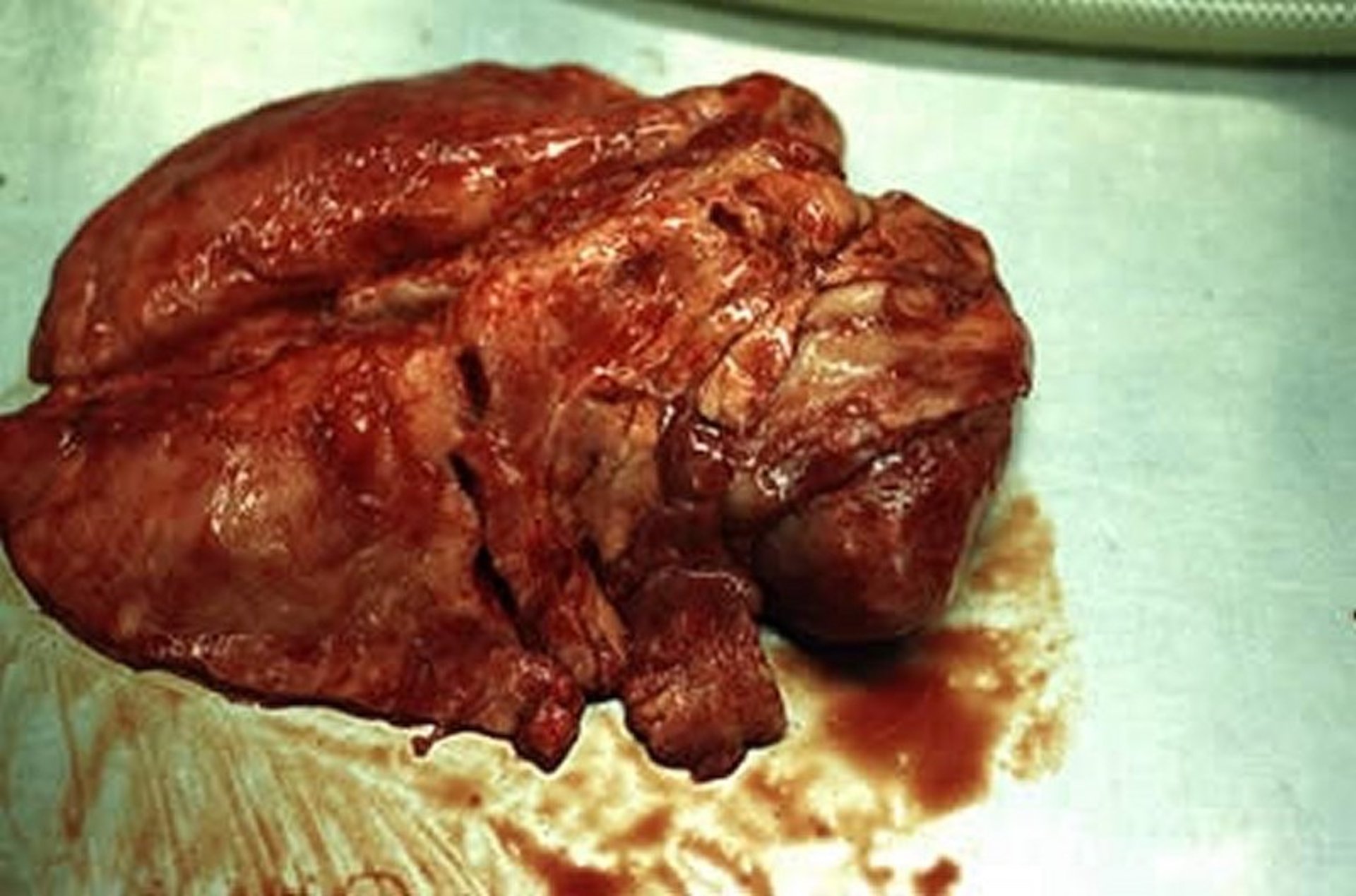 Infecção por <i >Actinobacillus pleuropneumoniae</i>, pulmão suíno