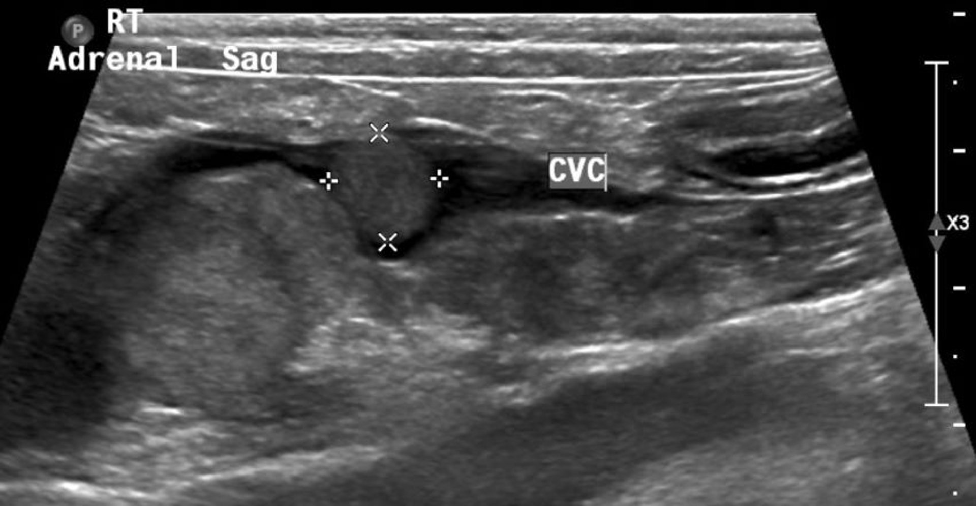 Adrenal tumor, ultrasonogram, dog
