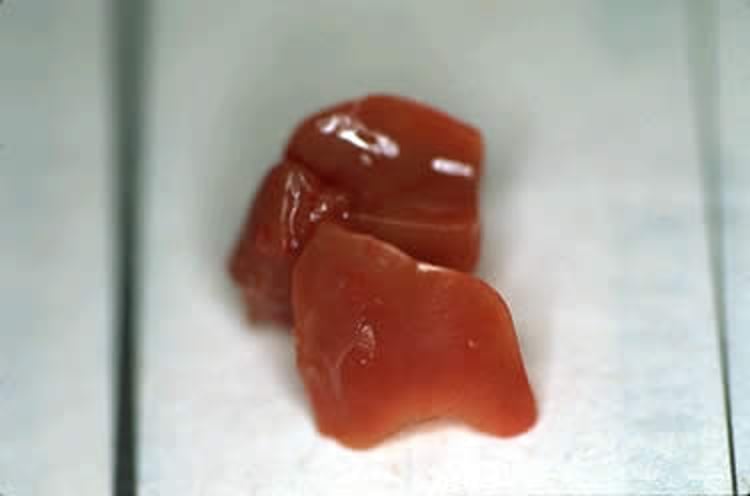 Amiloidosis, pinzón