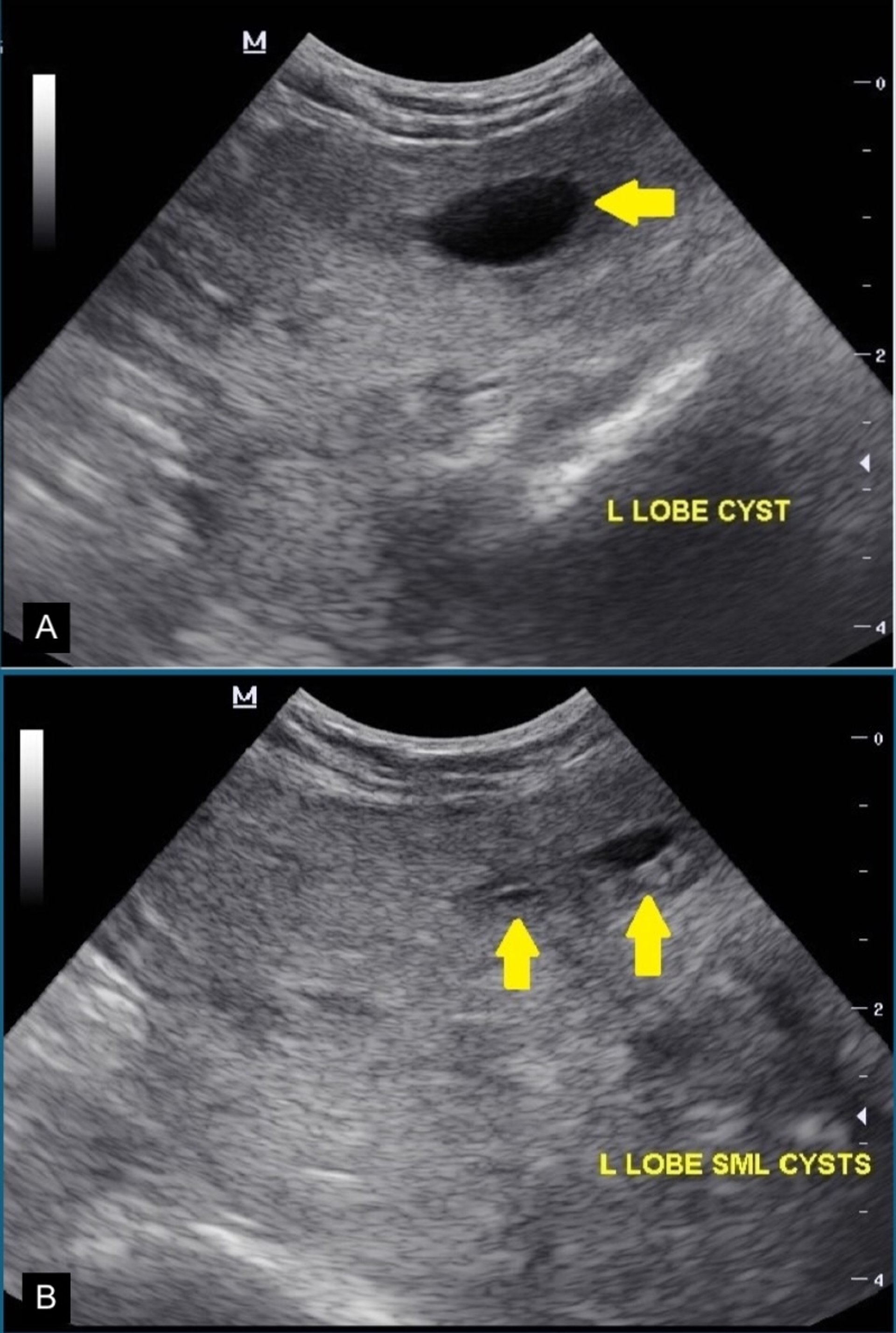 Cystic benign prostatic hyperplasia, transabdominal ultrasonography, dog