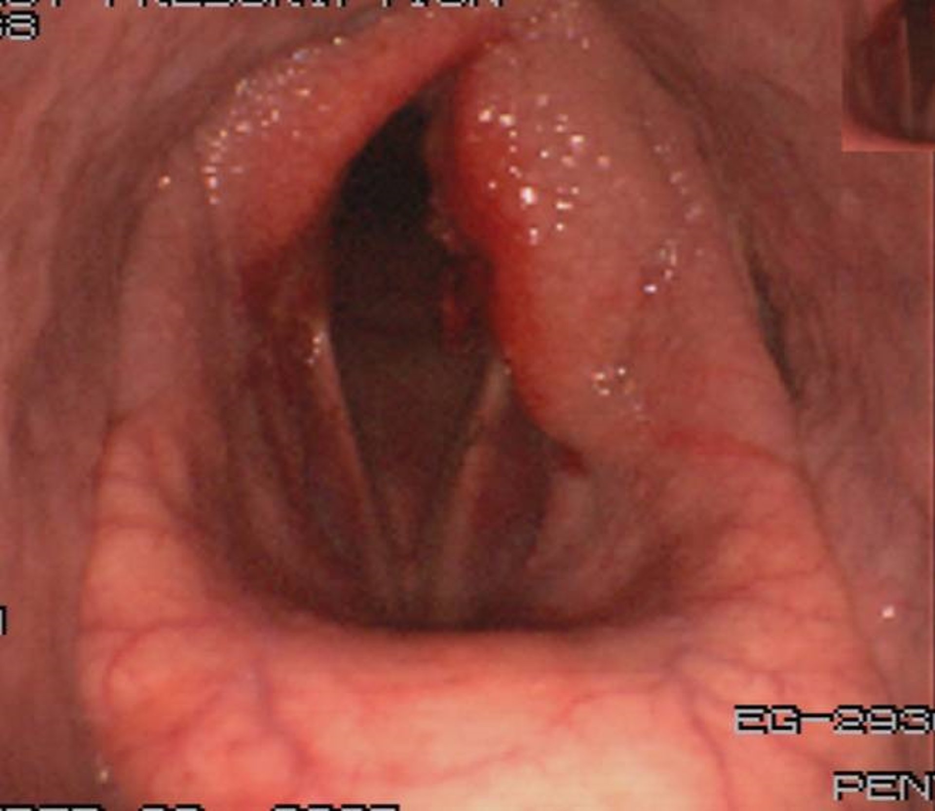 Condritis aritenoidea con tumefacción, caballo