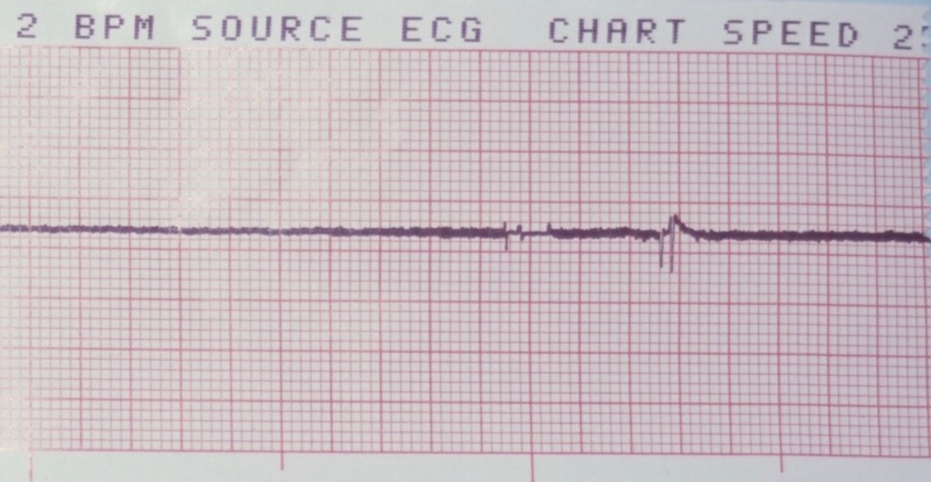 Asystole, ECG tracing