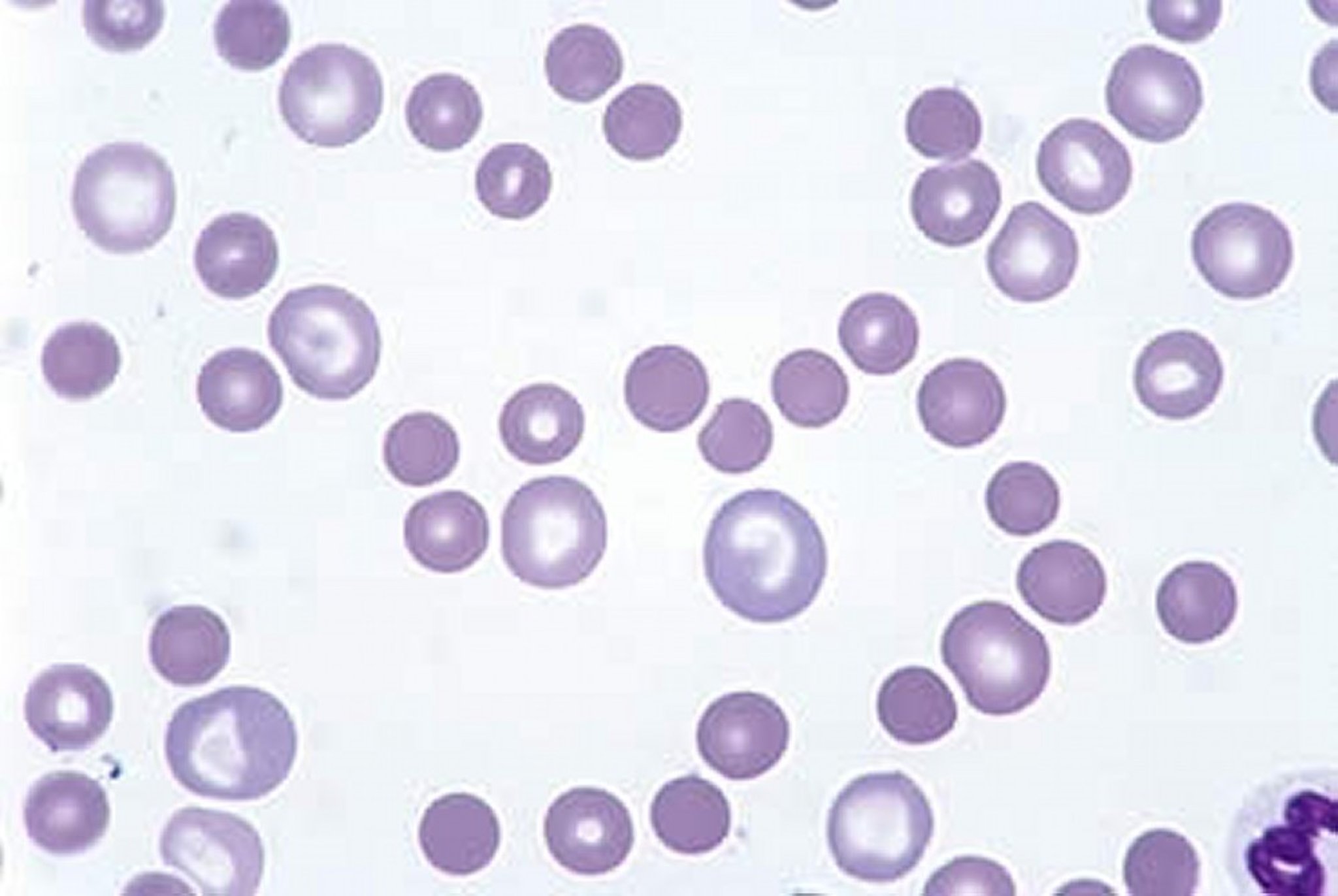 Anemia hemolítica autoimune, esfregaço de sangue (100X), cão