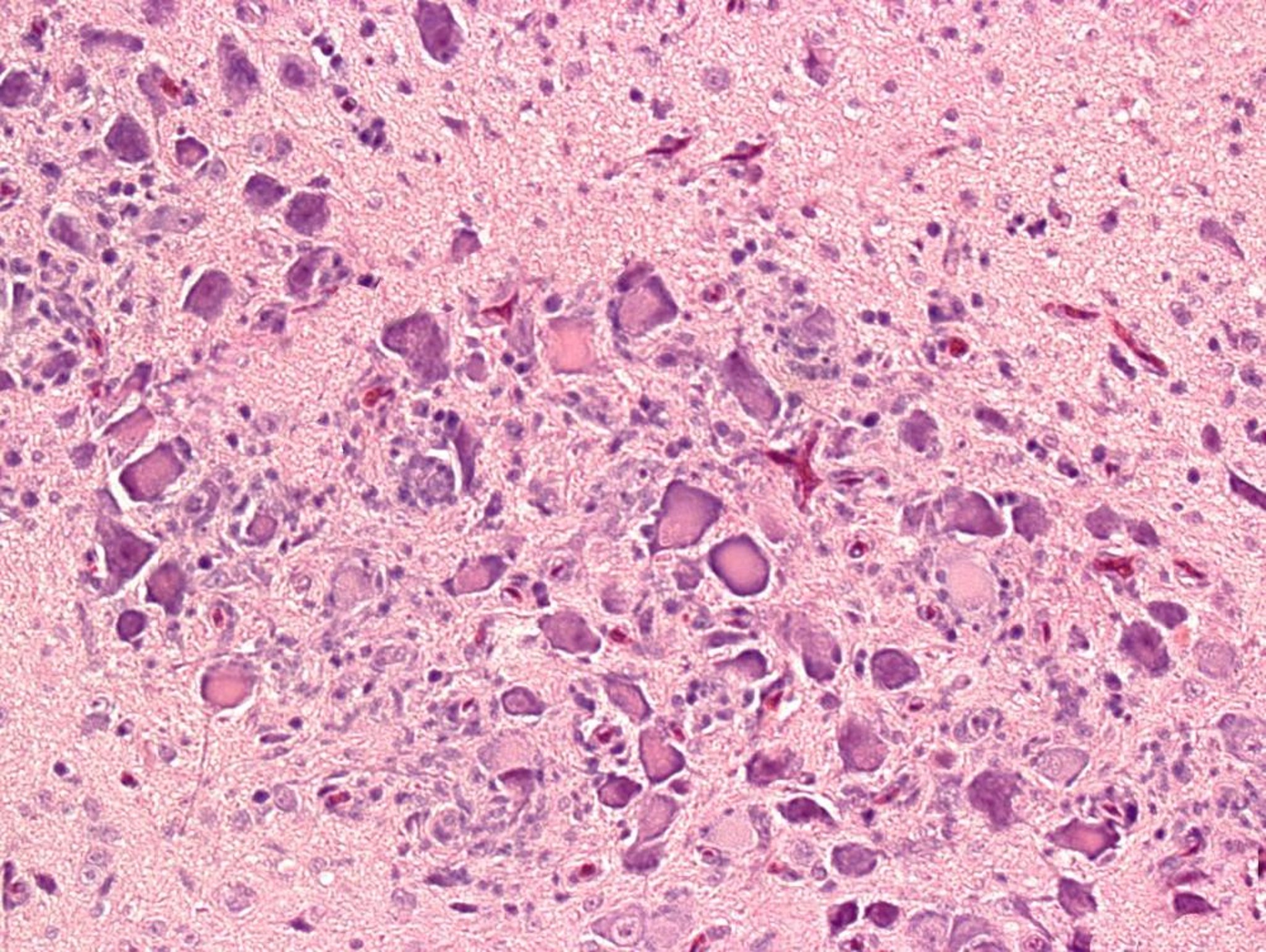 Avian encephalomyelitis, brain lesions, histopathology