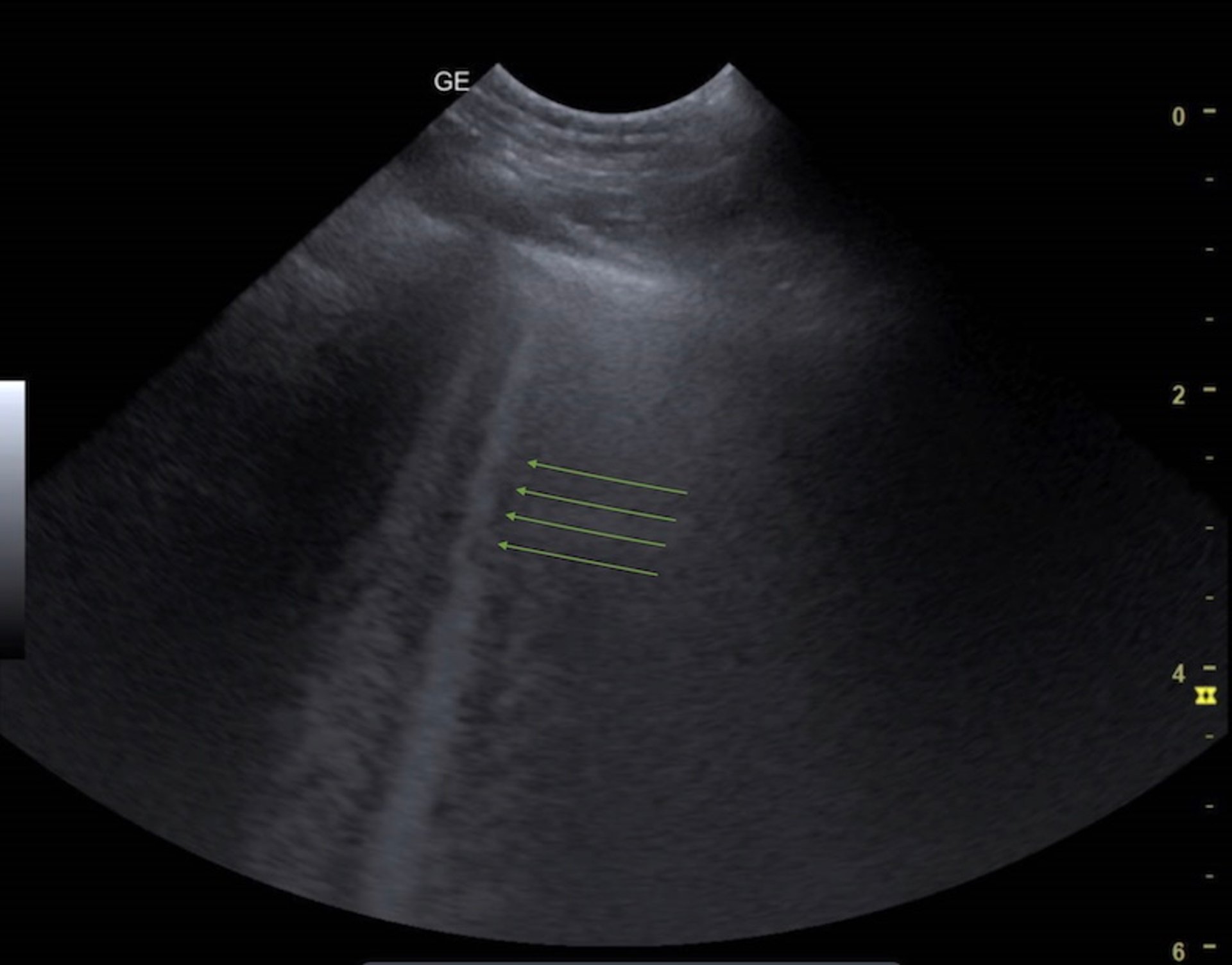 B-lines on a lung ultrasonogram