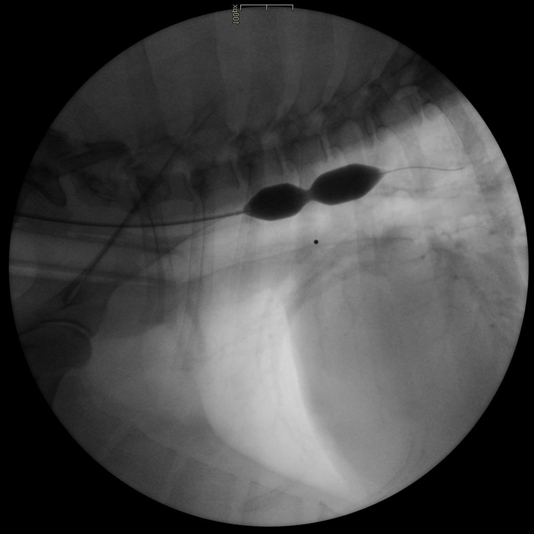 Balloon dilation, esophageal stricture, dog