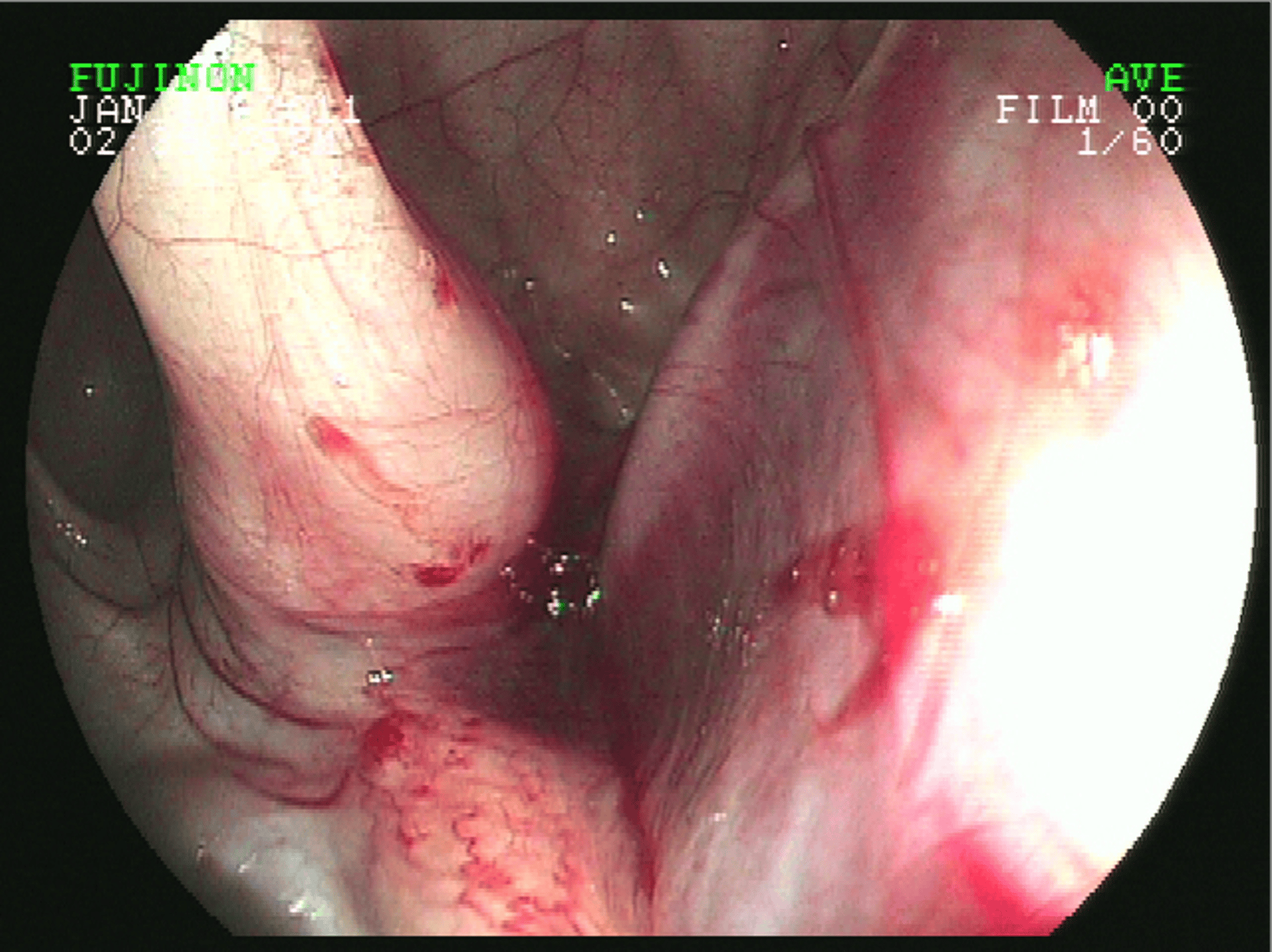 Basisphenoid fracture, upper airway endoscopy, horse