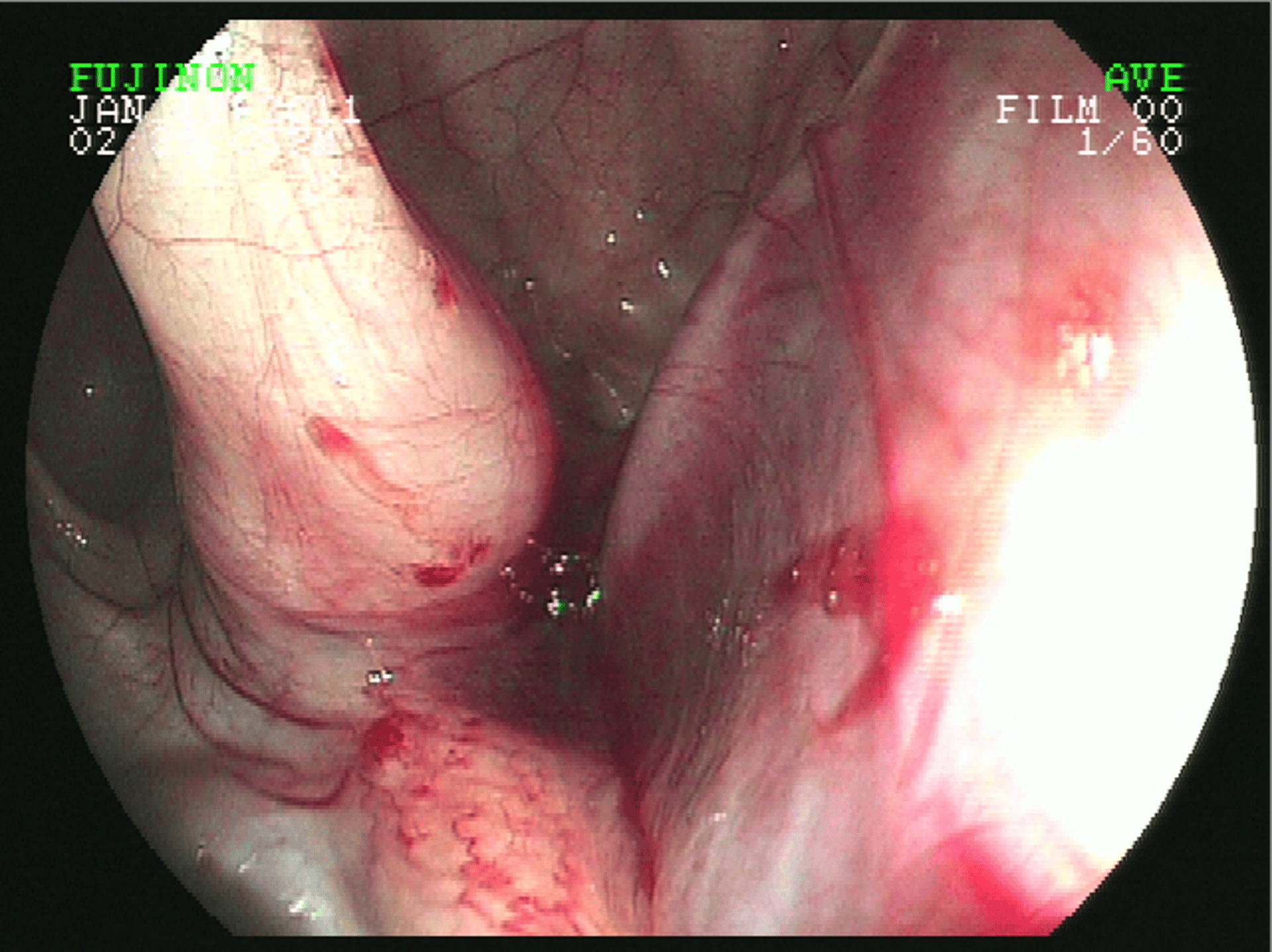 Fractura basifenoide, endoscopia de la vía respiratoria superior, caballo