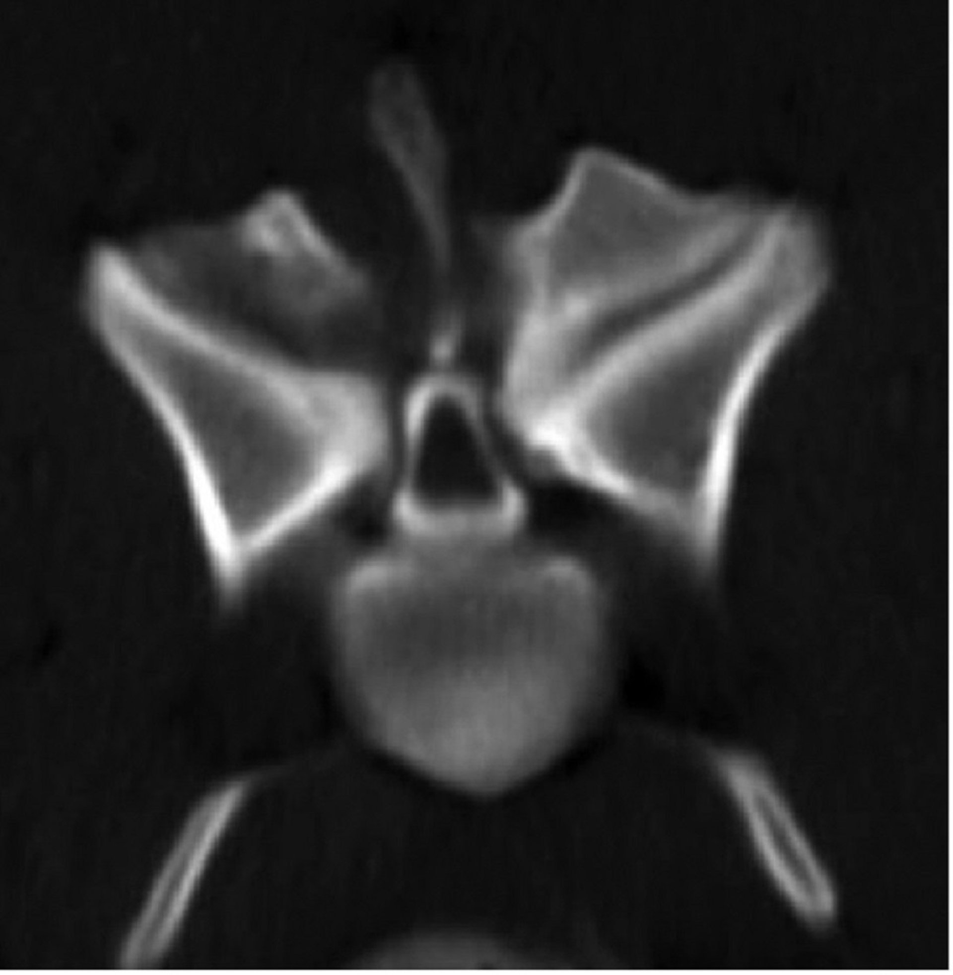 Bony-associated spondylomyelopathy, dog