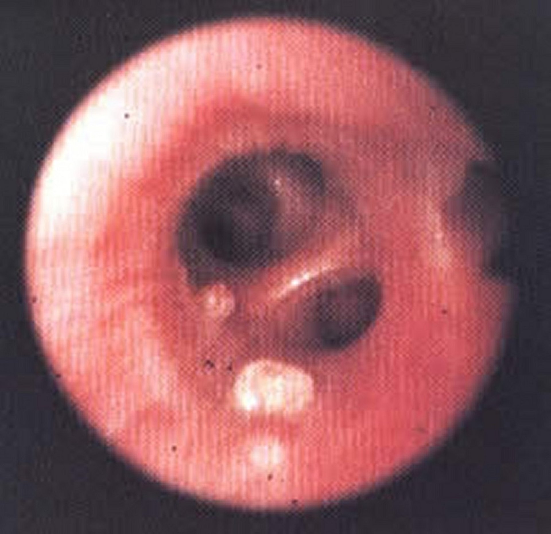 Nodules of <i >Oslerus osleri</i>, bronchoscopy