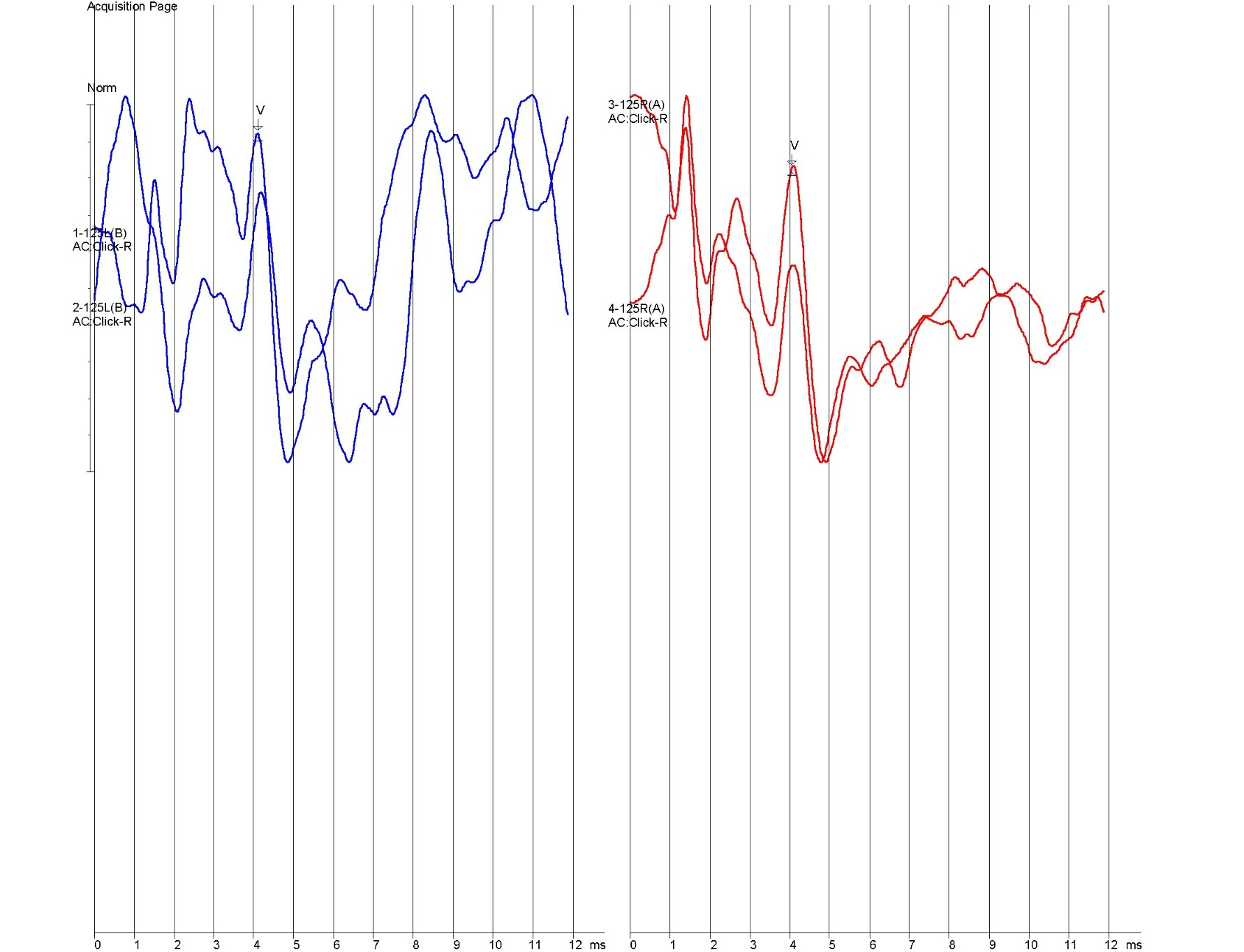 Brainstem auditory evoked response (BAER) testing output, normal, dog