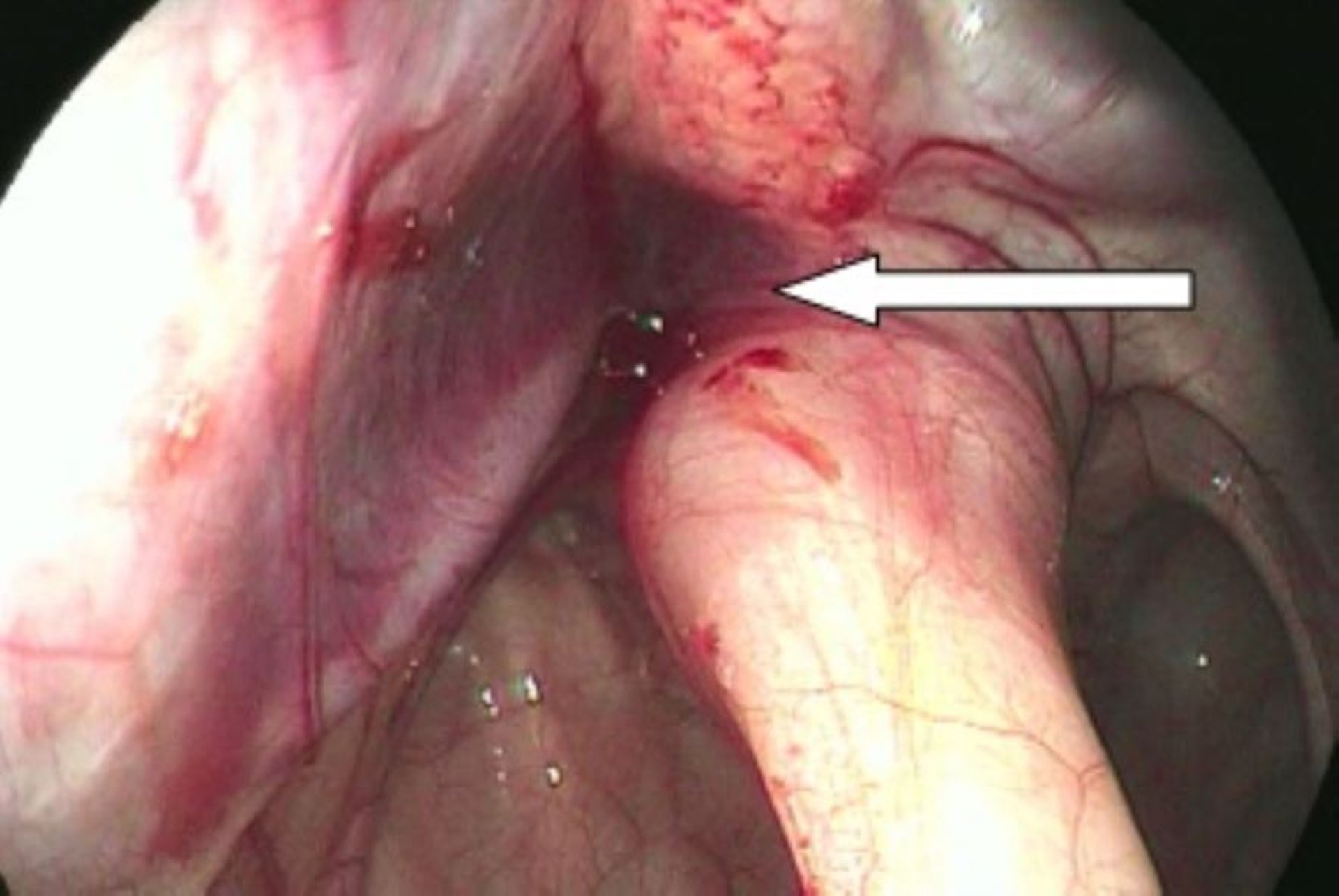 Basisphenoid fracture, endoscopic image, horse