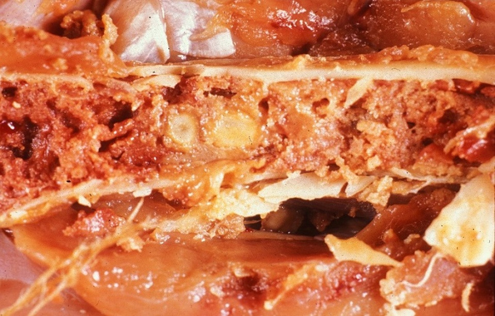Bone marrow granuloma, tuberculosis, poultry