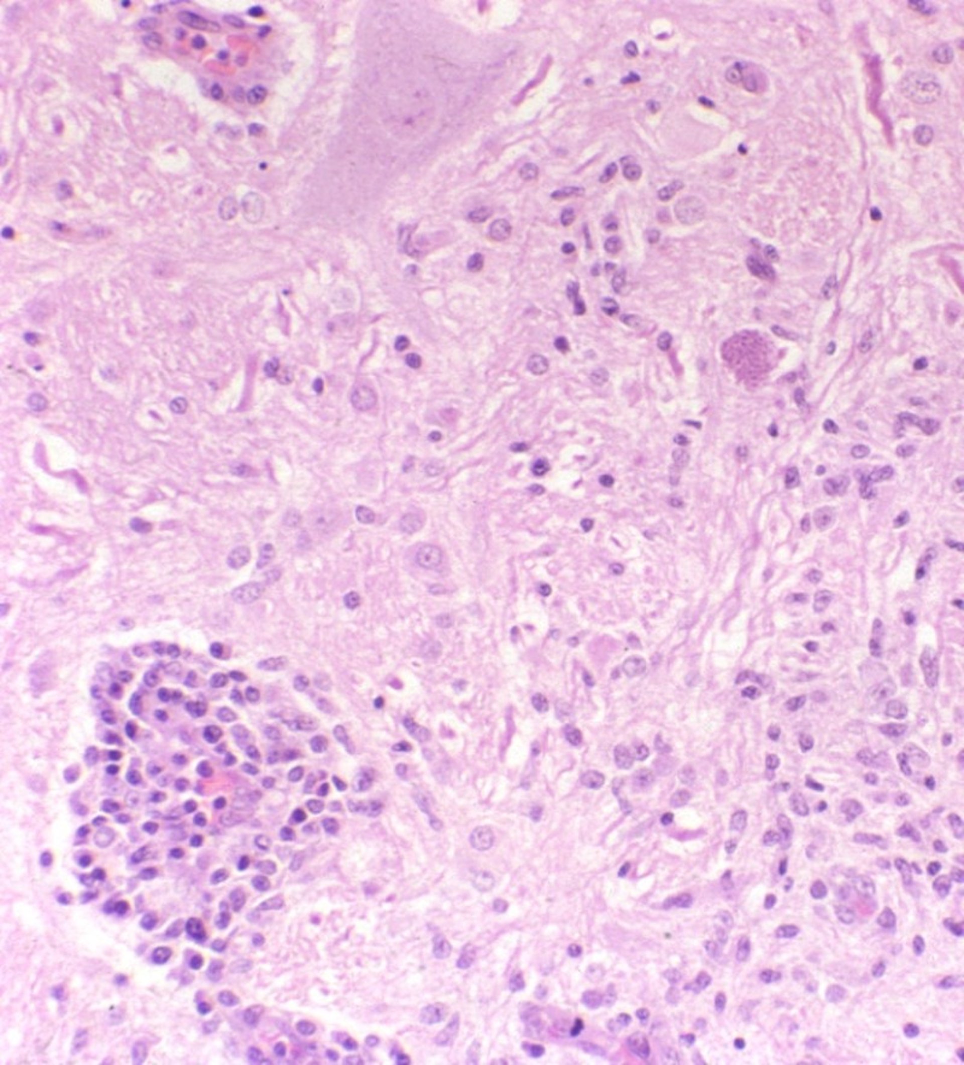 Inflamación cerebral, perro