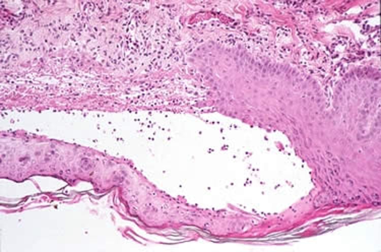 Bullous pemphigoid, histopathologic lesions, dog