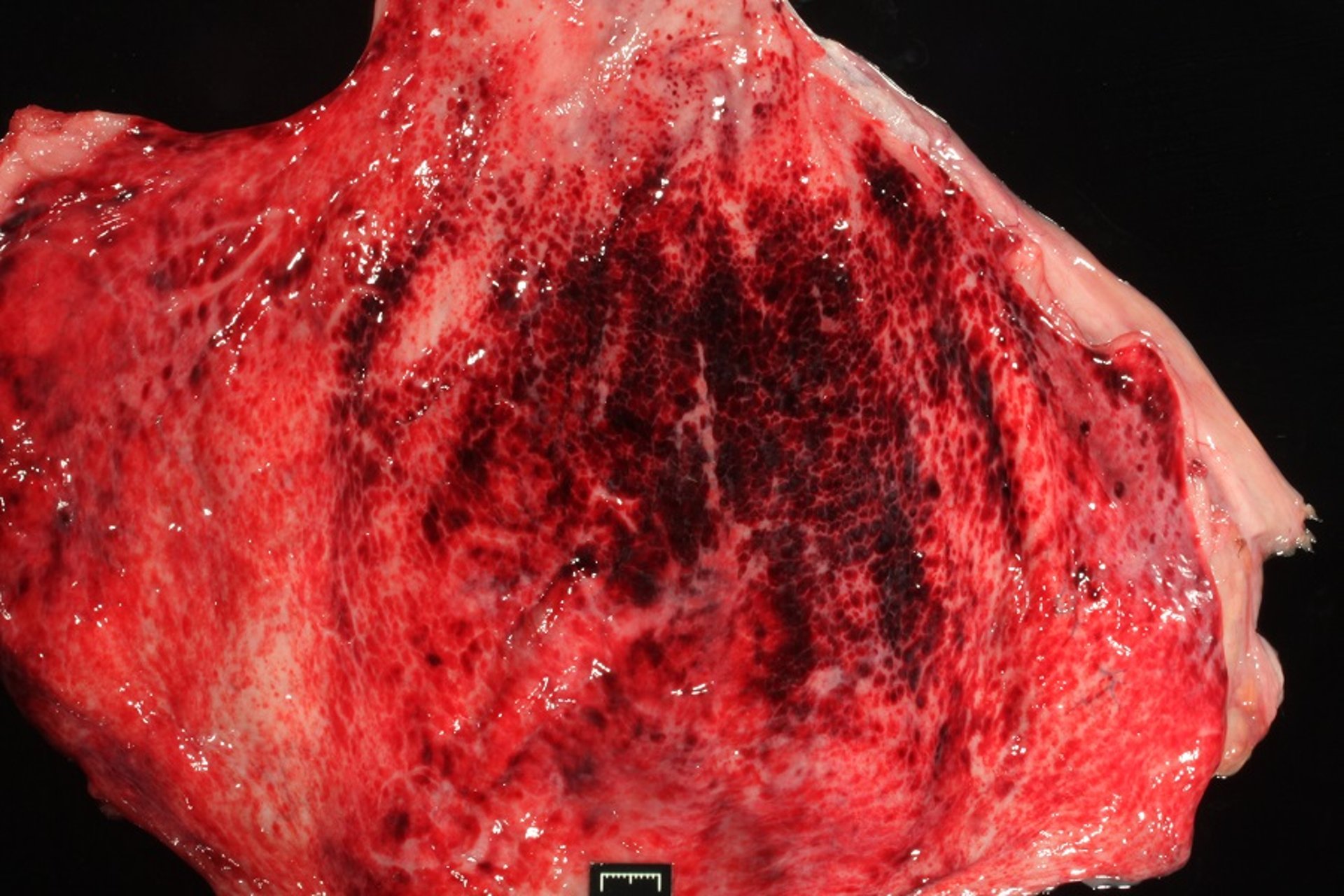 Hemorrhagic cystitis, cantharidin toxicosis